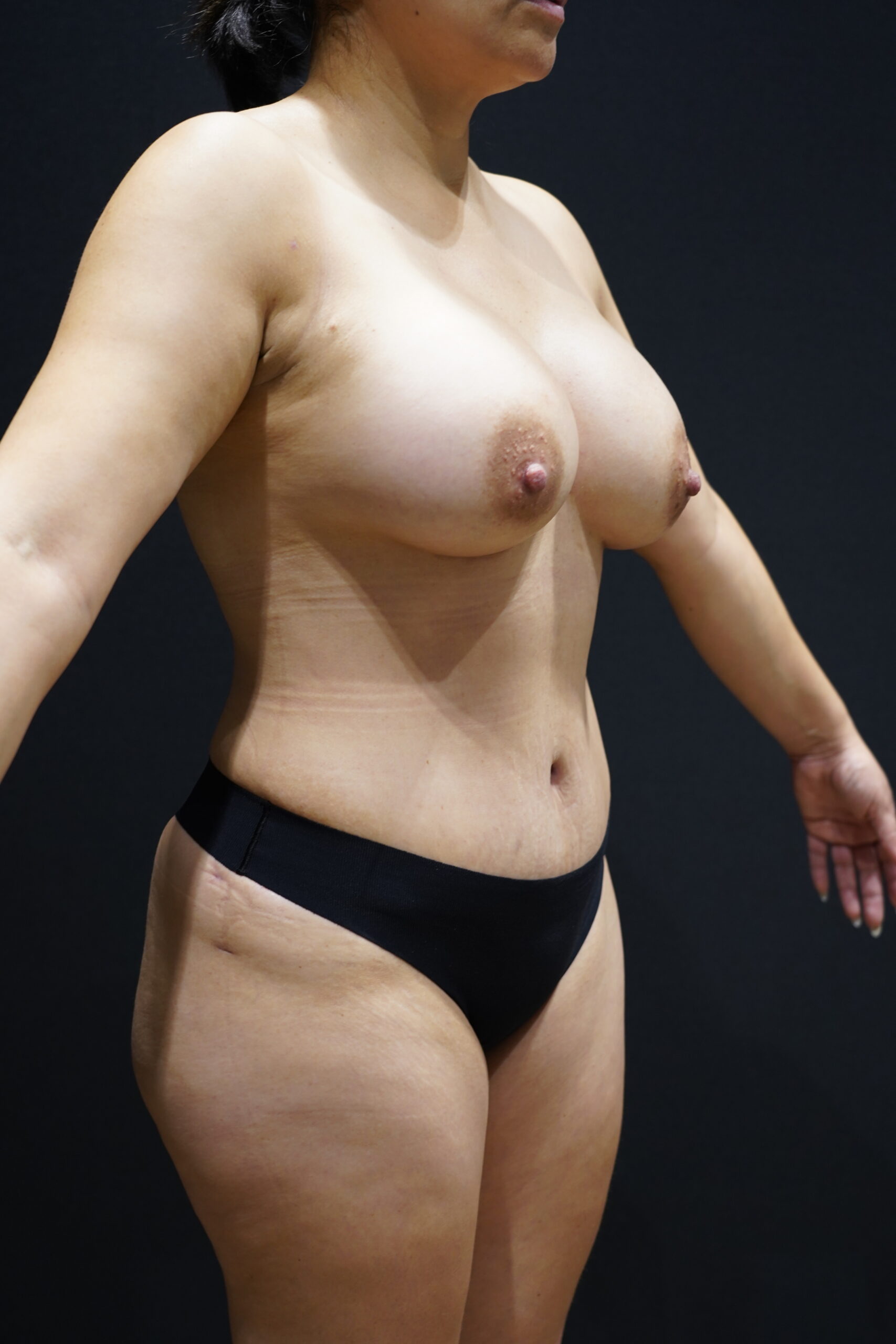 After photo - 45° view