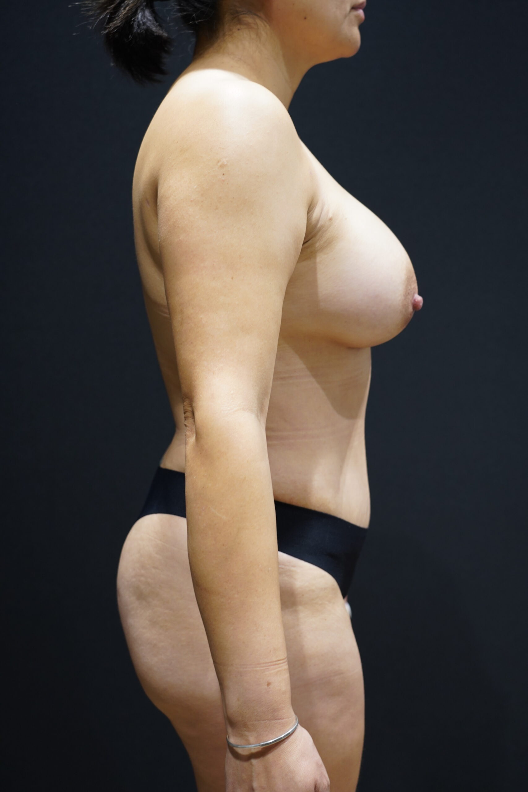 After photo - 90° view