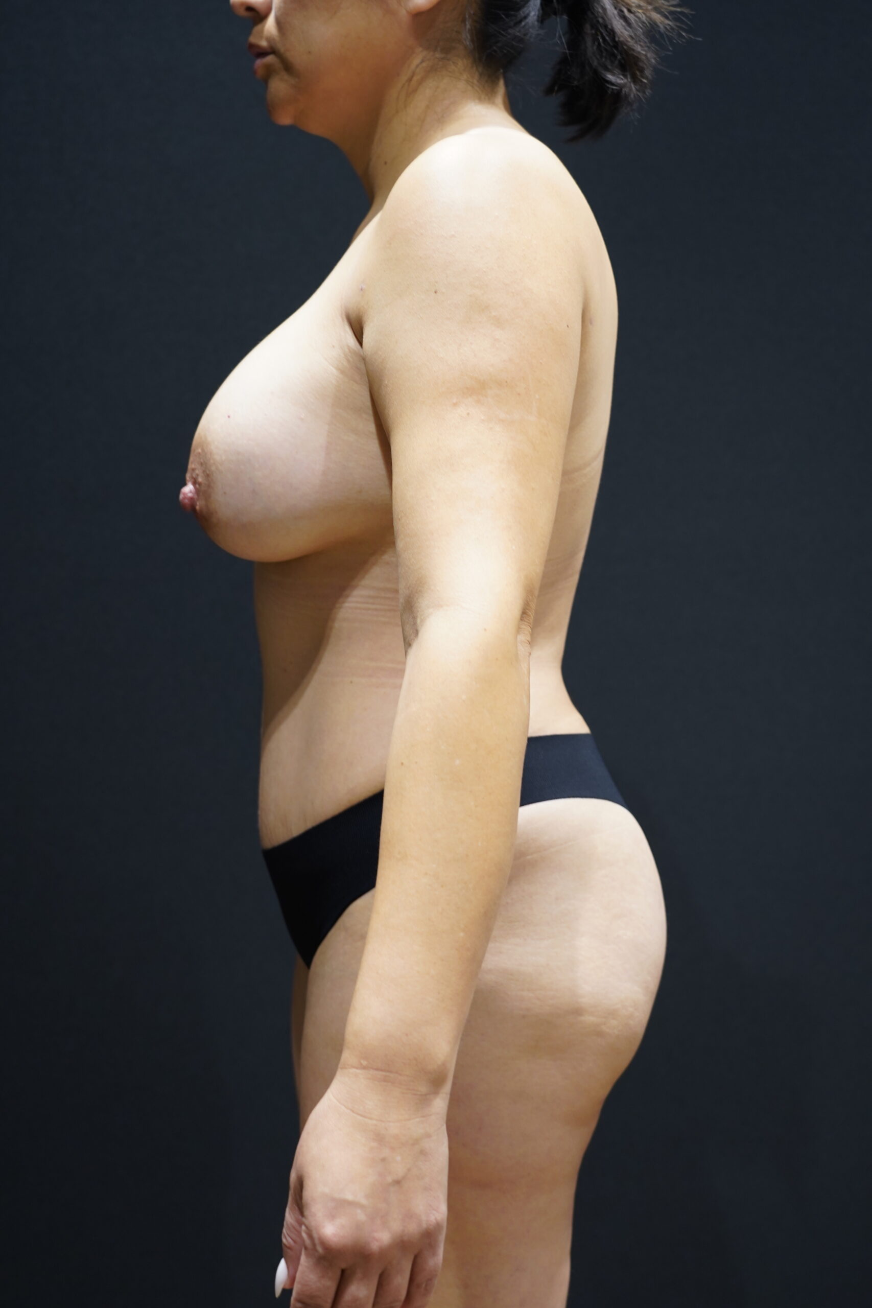 After photo - -90° view