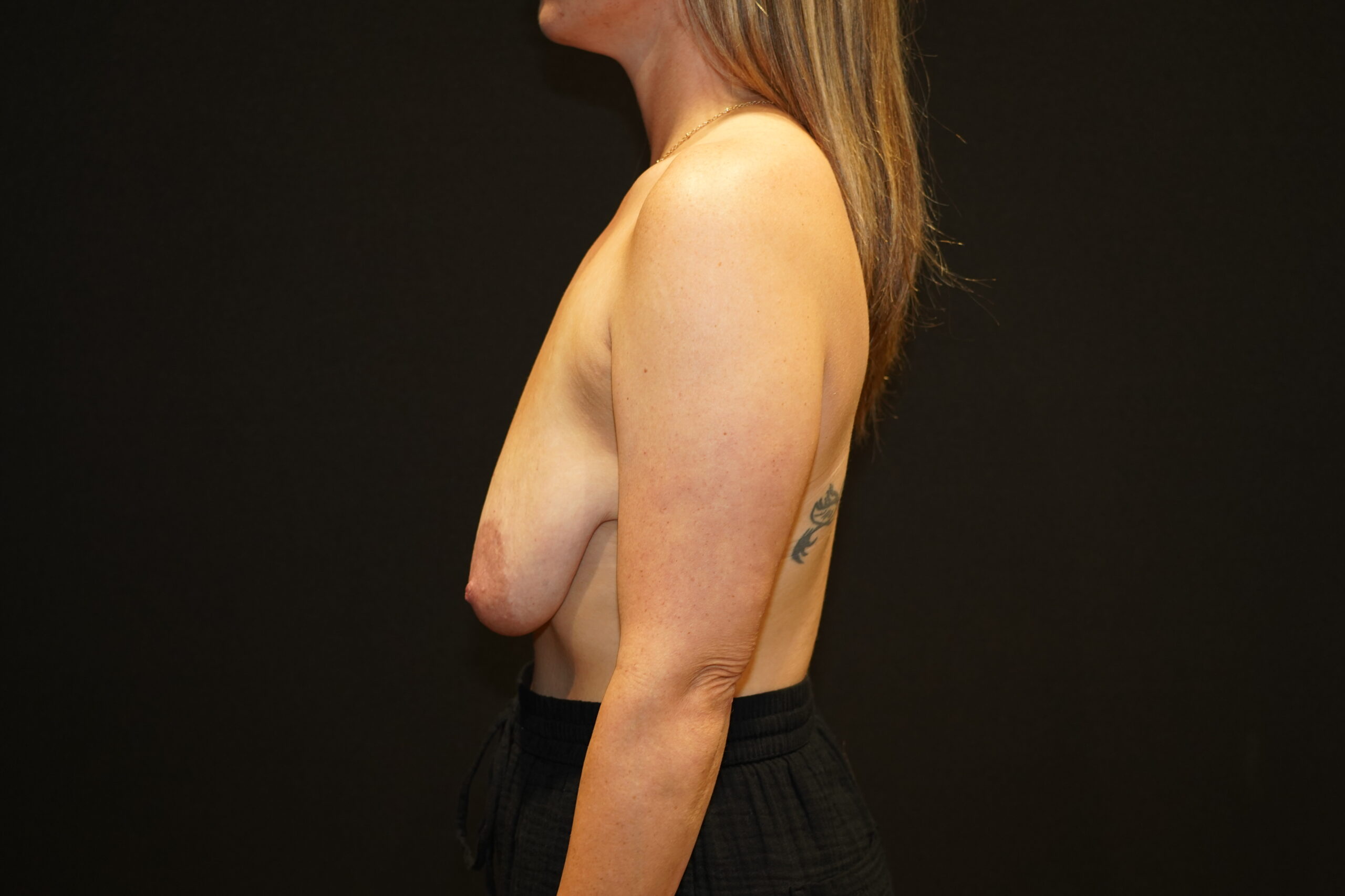 Case--3611 | Before Breast Lift/Mastopexy 2