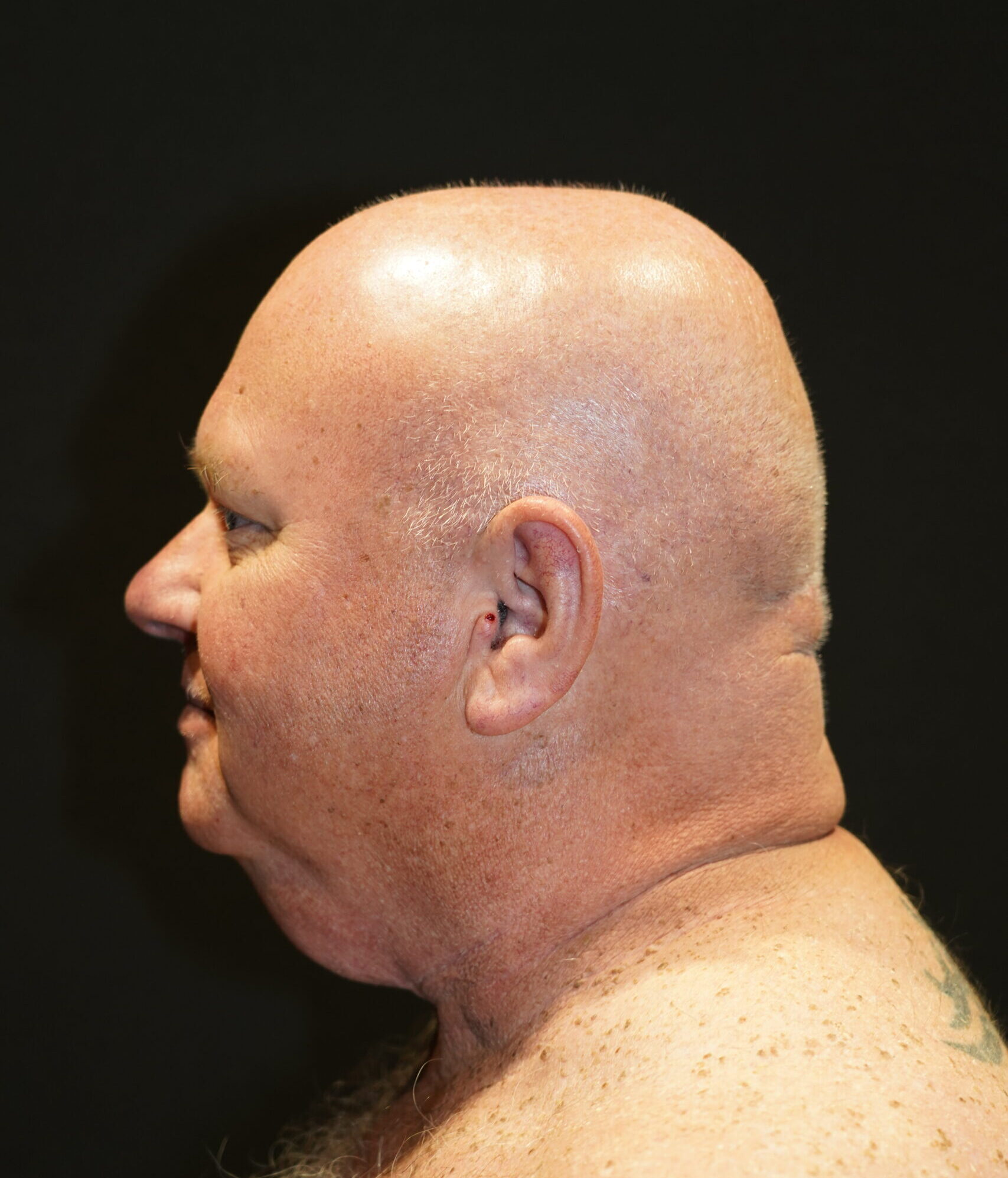 Before photo - -90° view