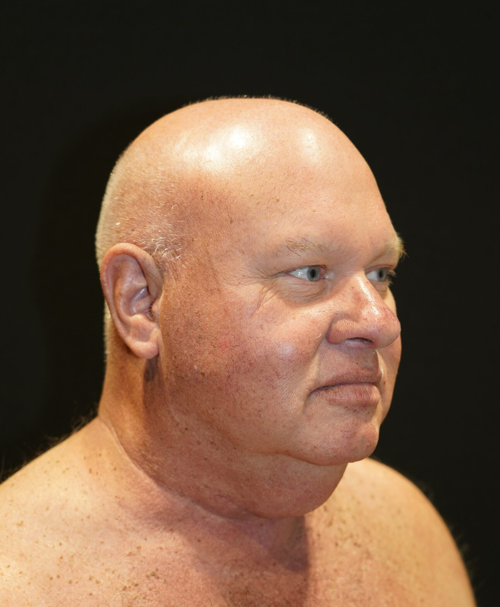 Before photo - -45° view