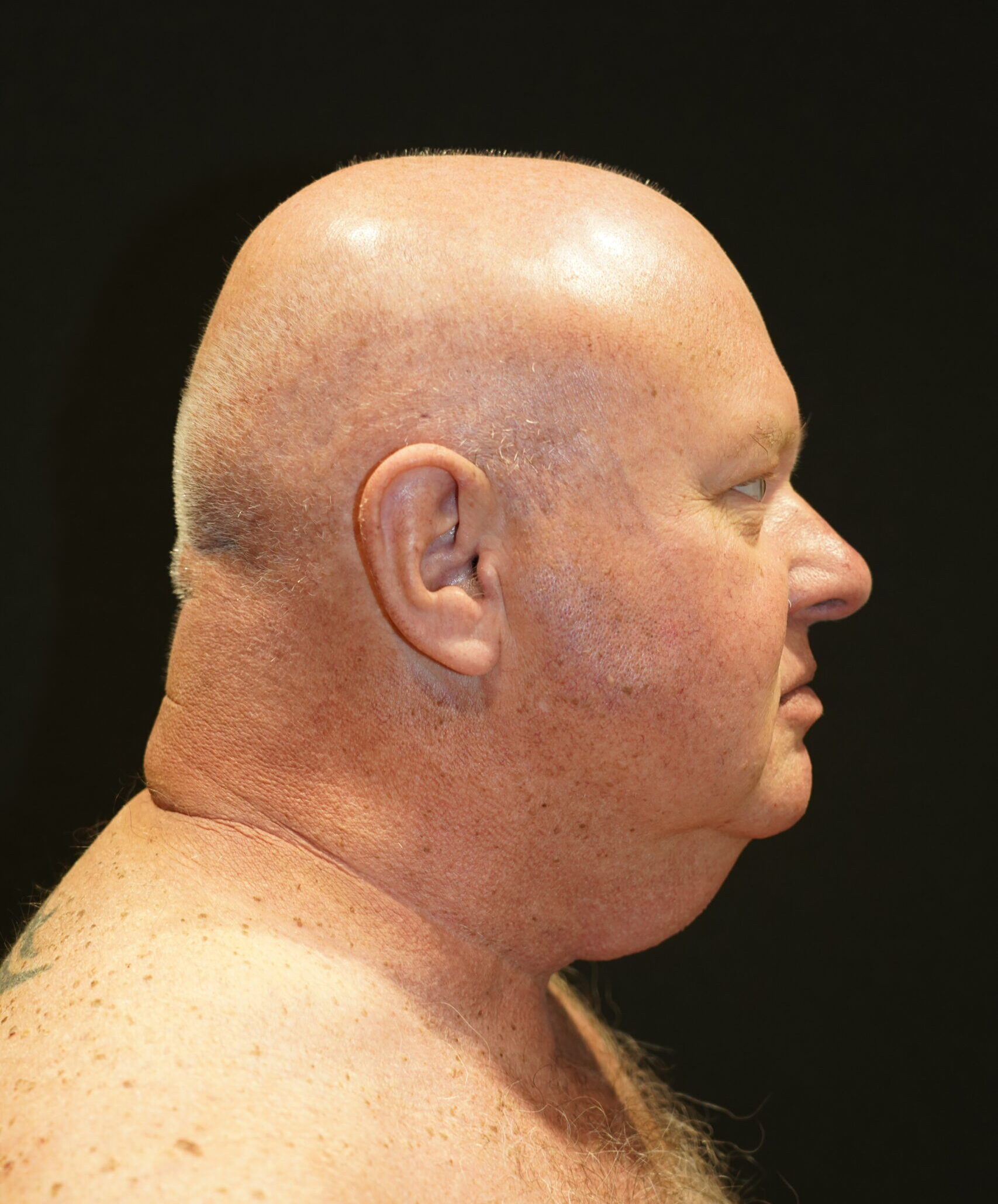 Before photo - 90° view