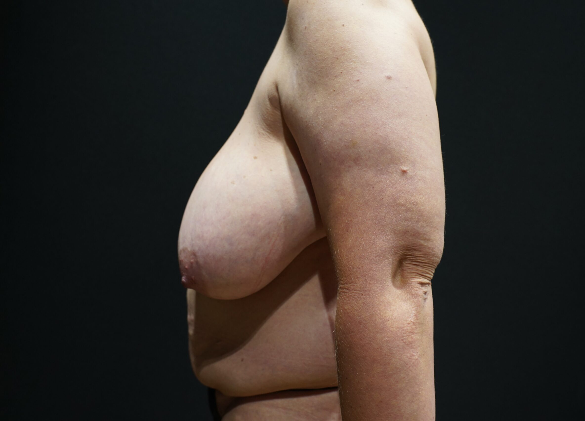 Before photo - -90° view