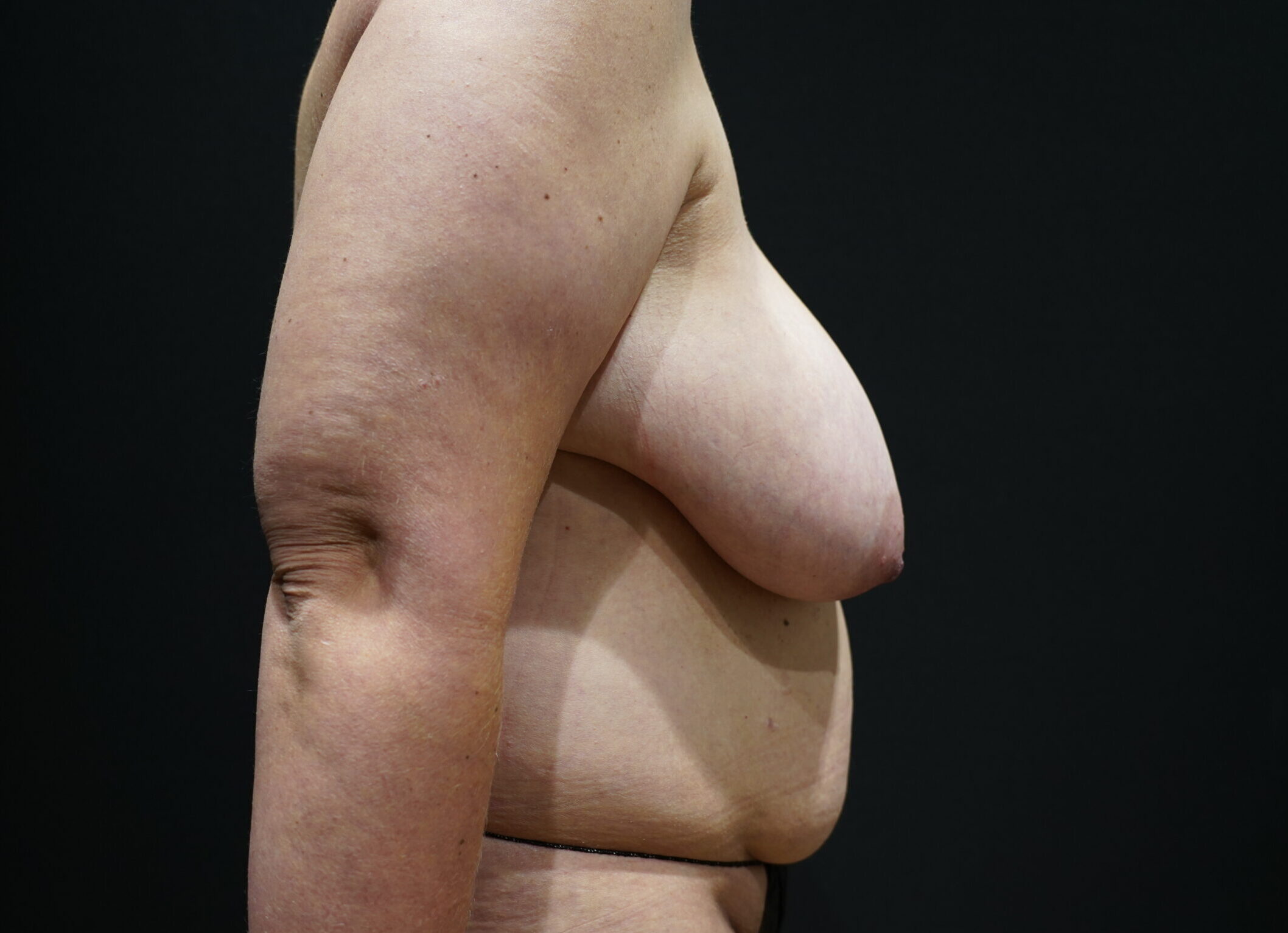 Before photo - 90° view