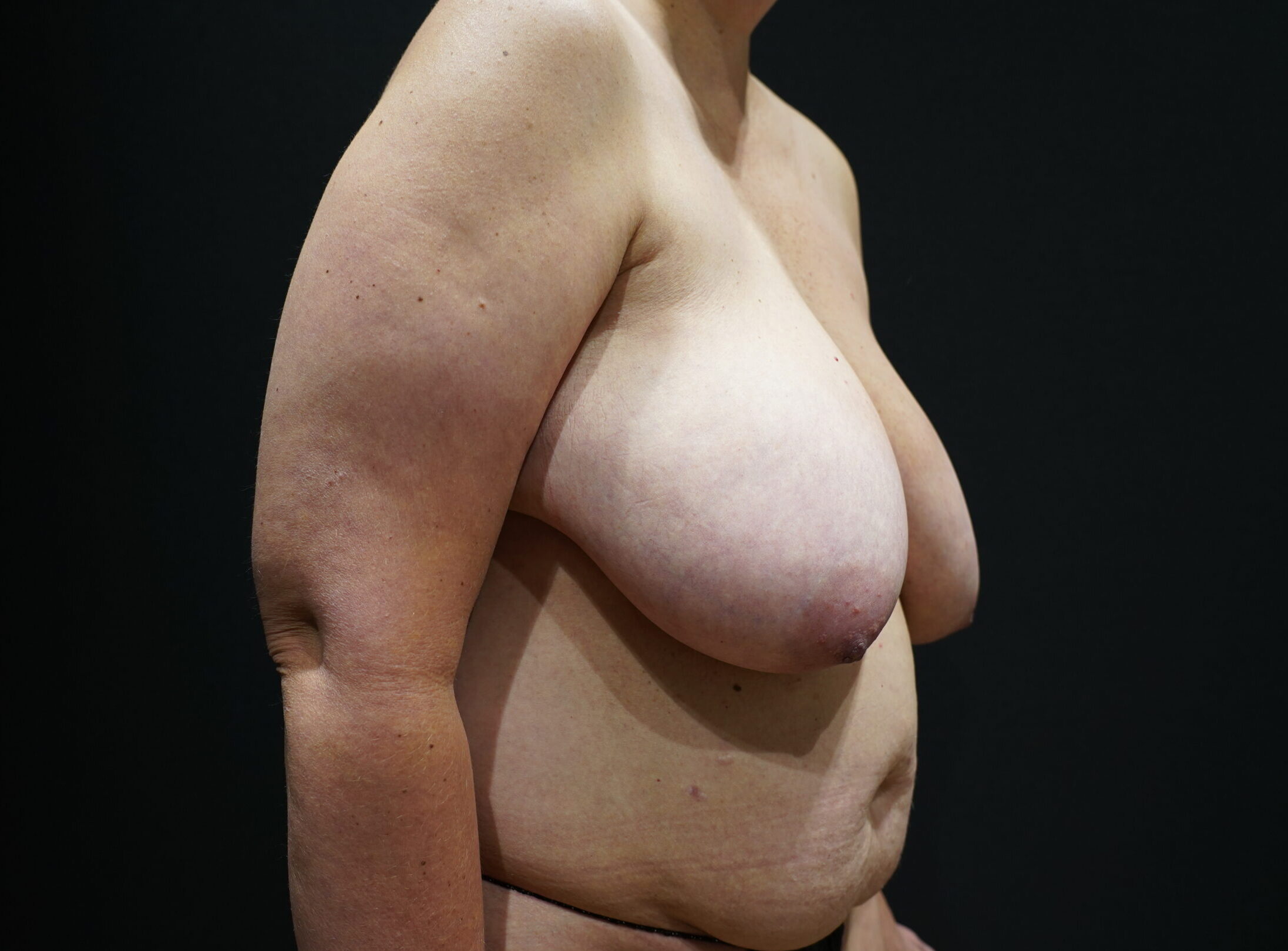 Before photo - 45° view