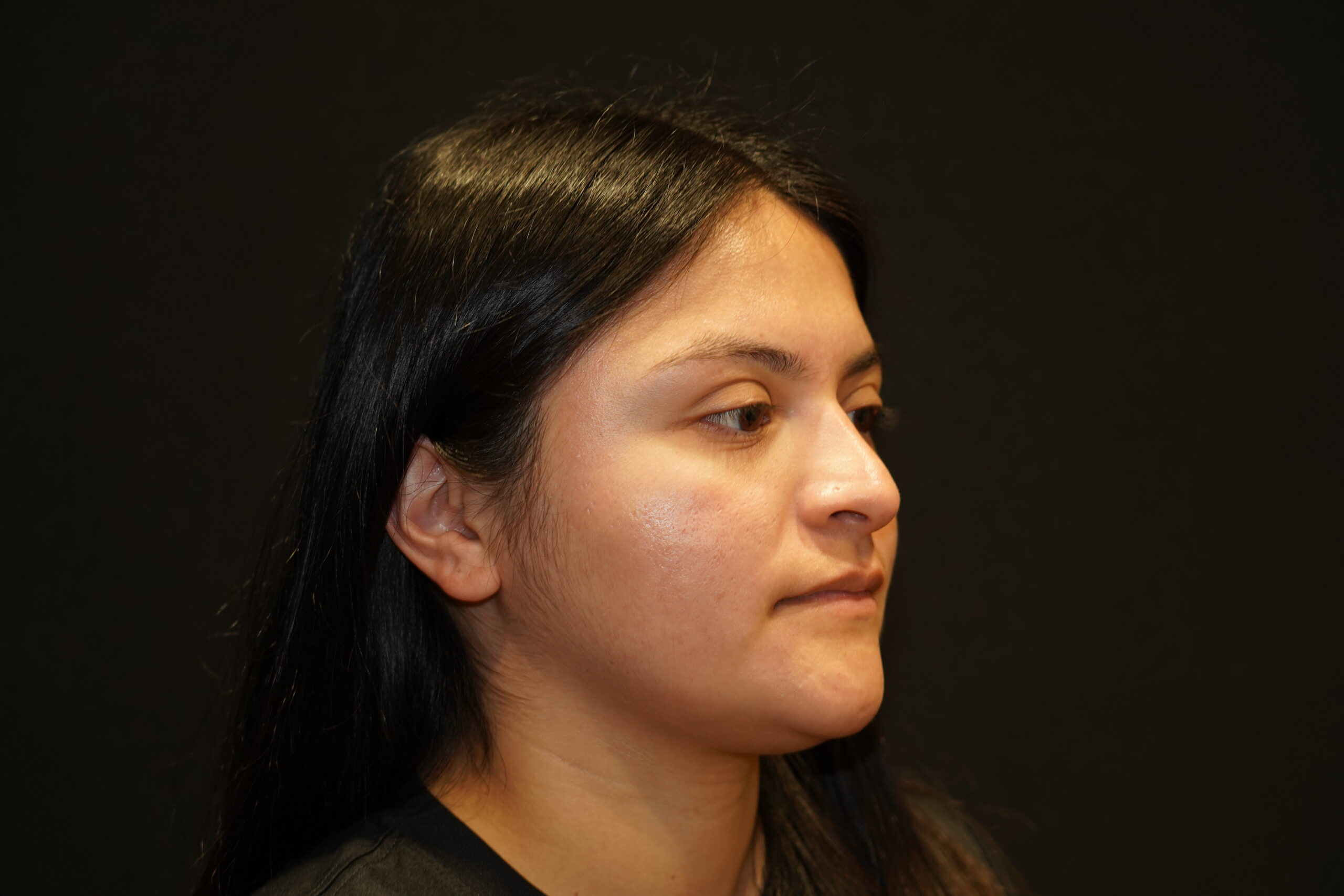 Before photo - 45° view