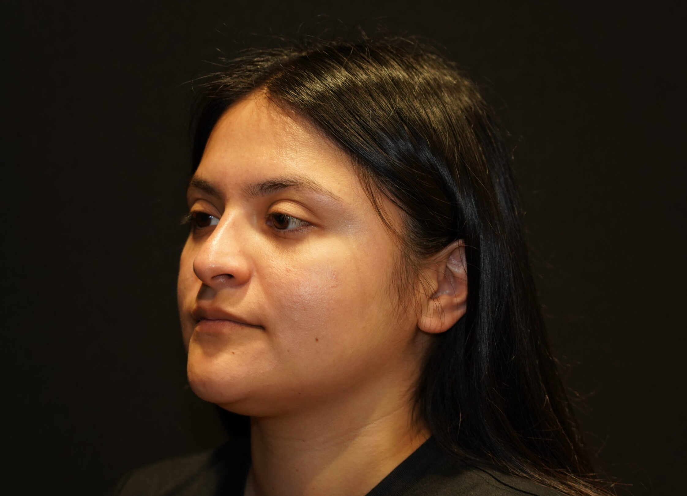 Before photo - -45° view