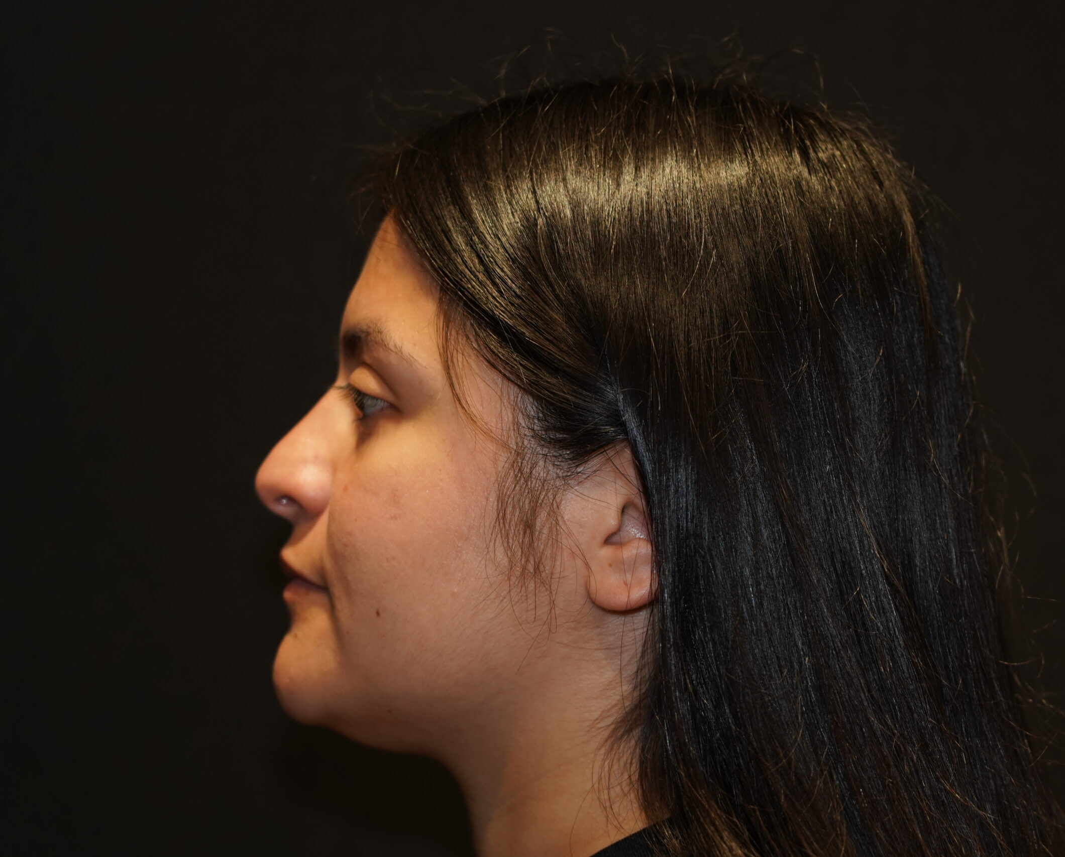 Before photo - -90° view