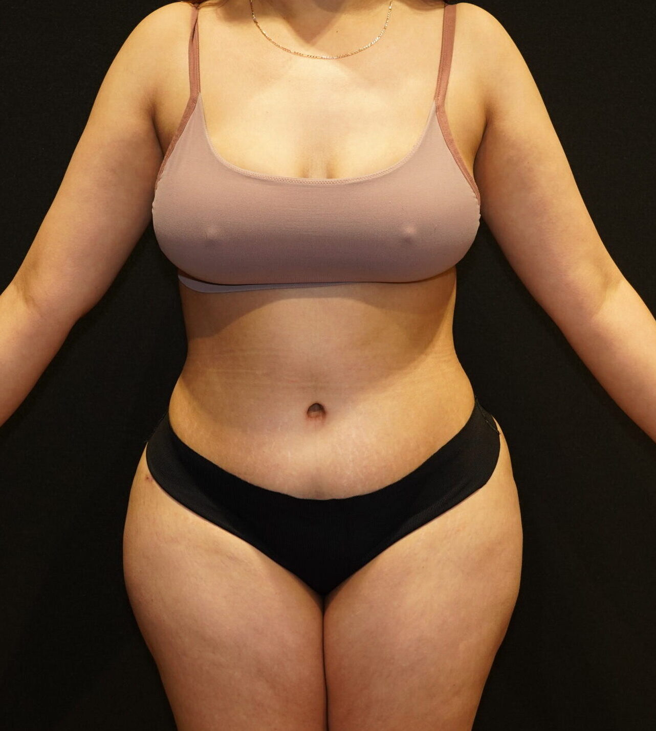 After photo - 0° view