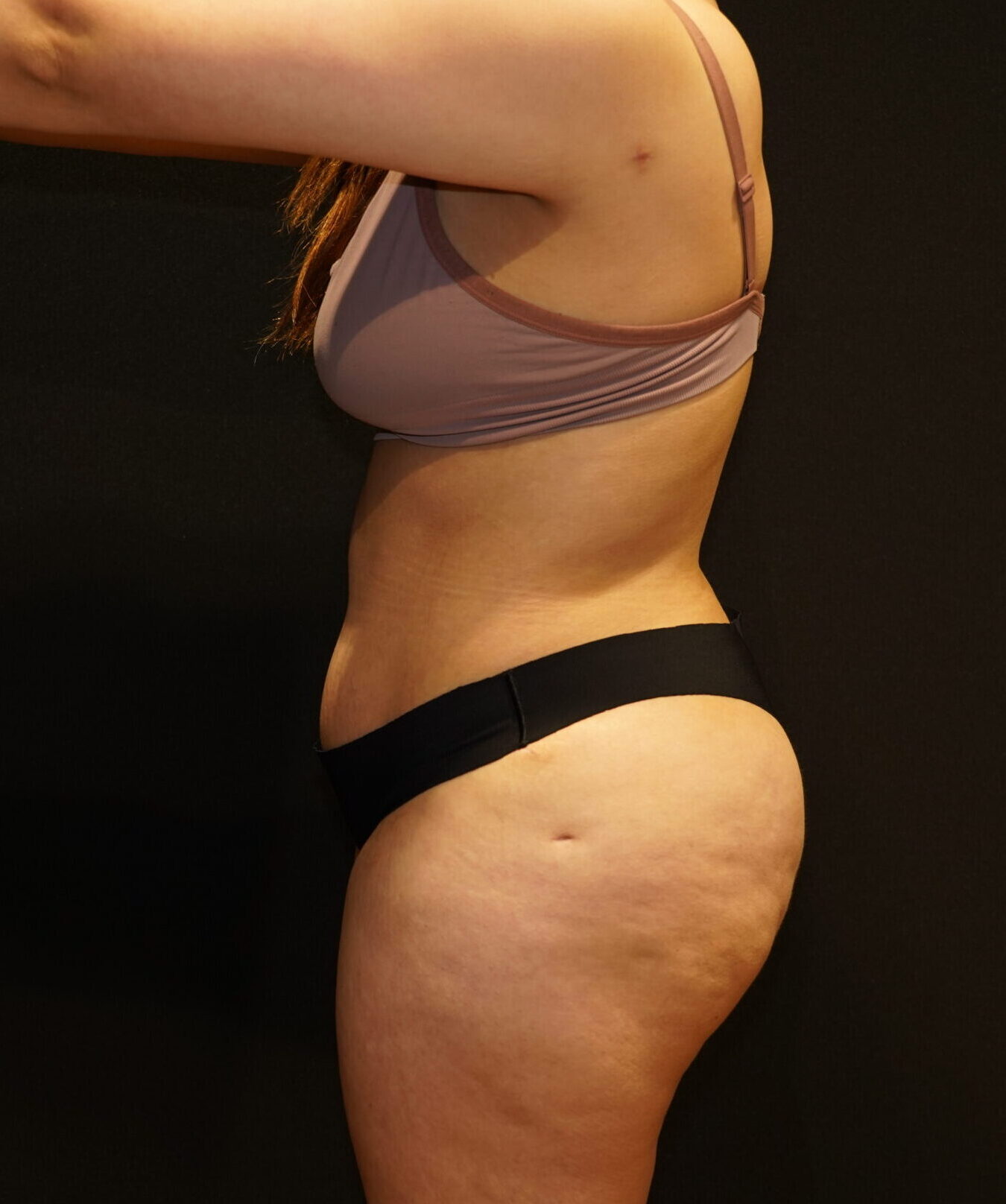 After photo - 90° view