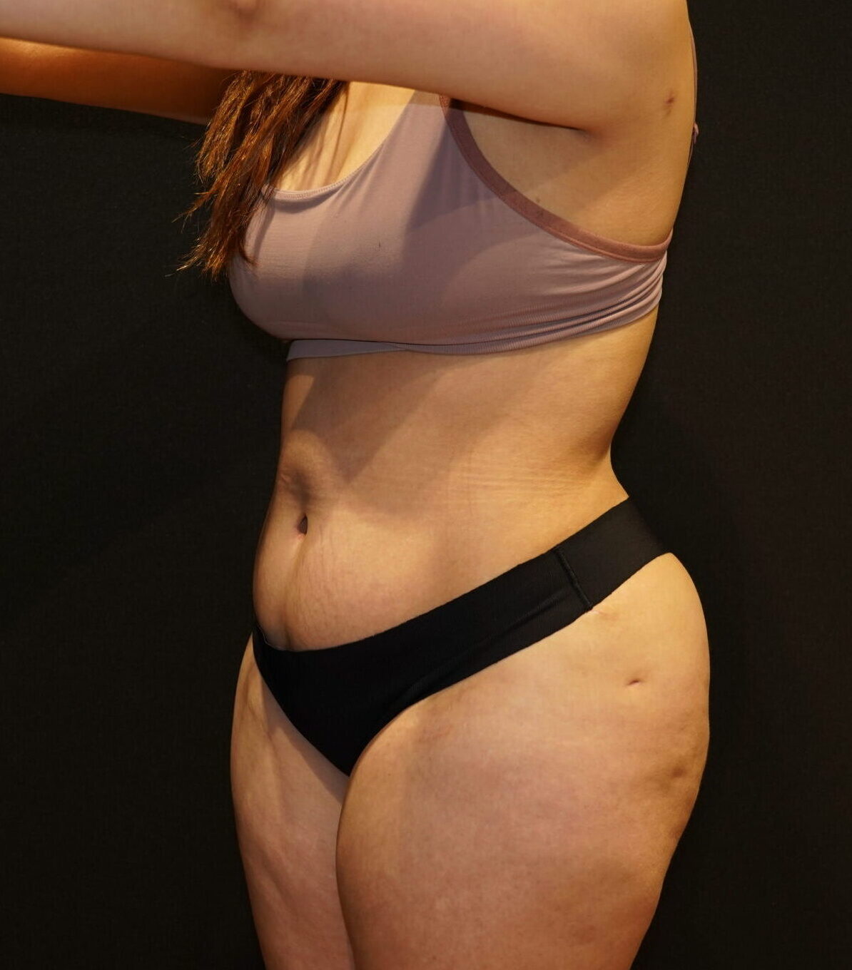 After photo - 45° view