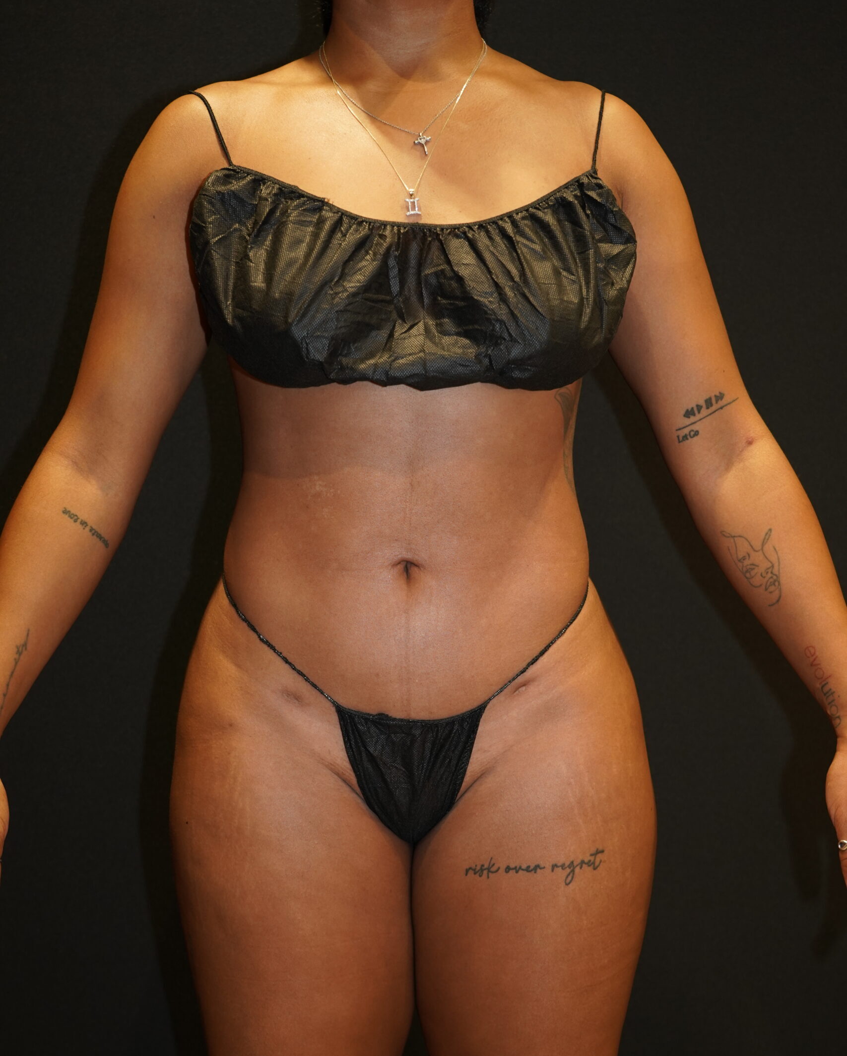 After photo - 0° view