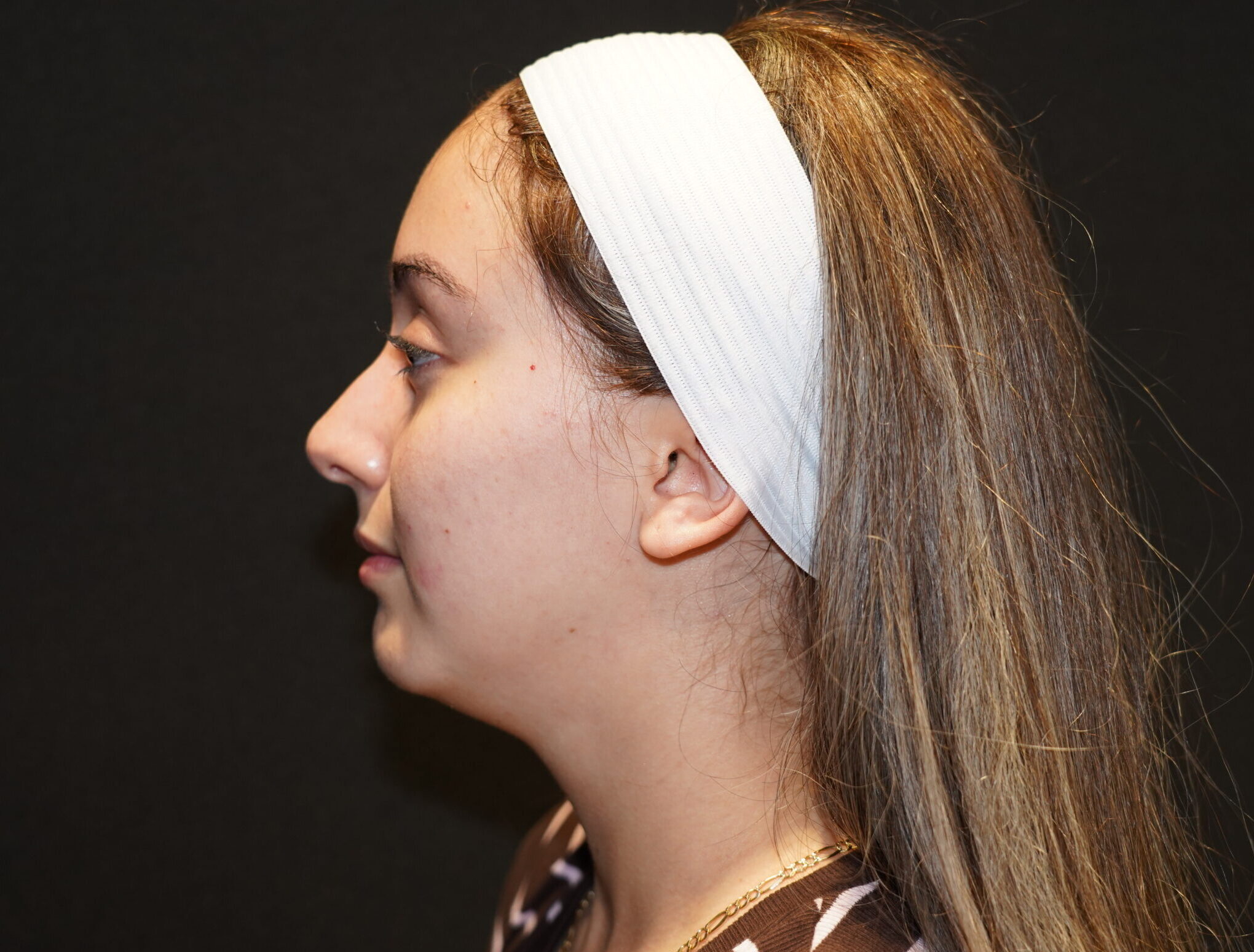 Before photo - -90° view