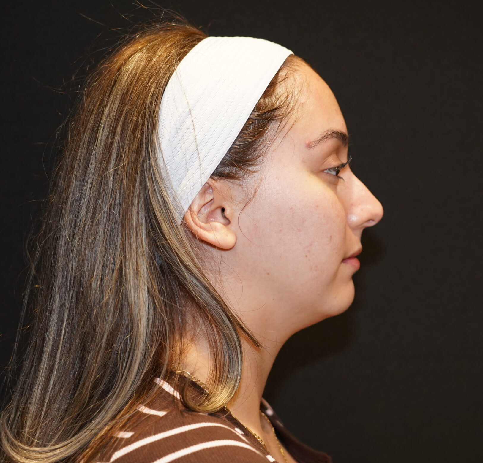 Before photo - 90° view