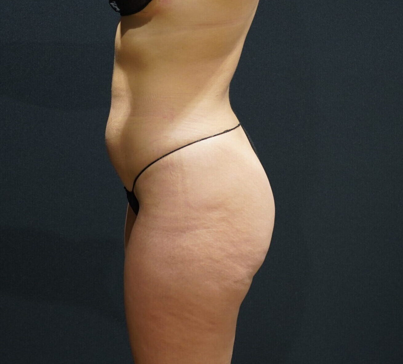 Before photo - -90° view