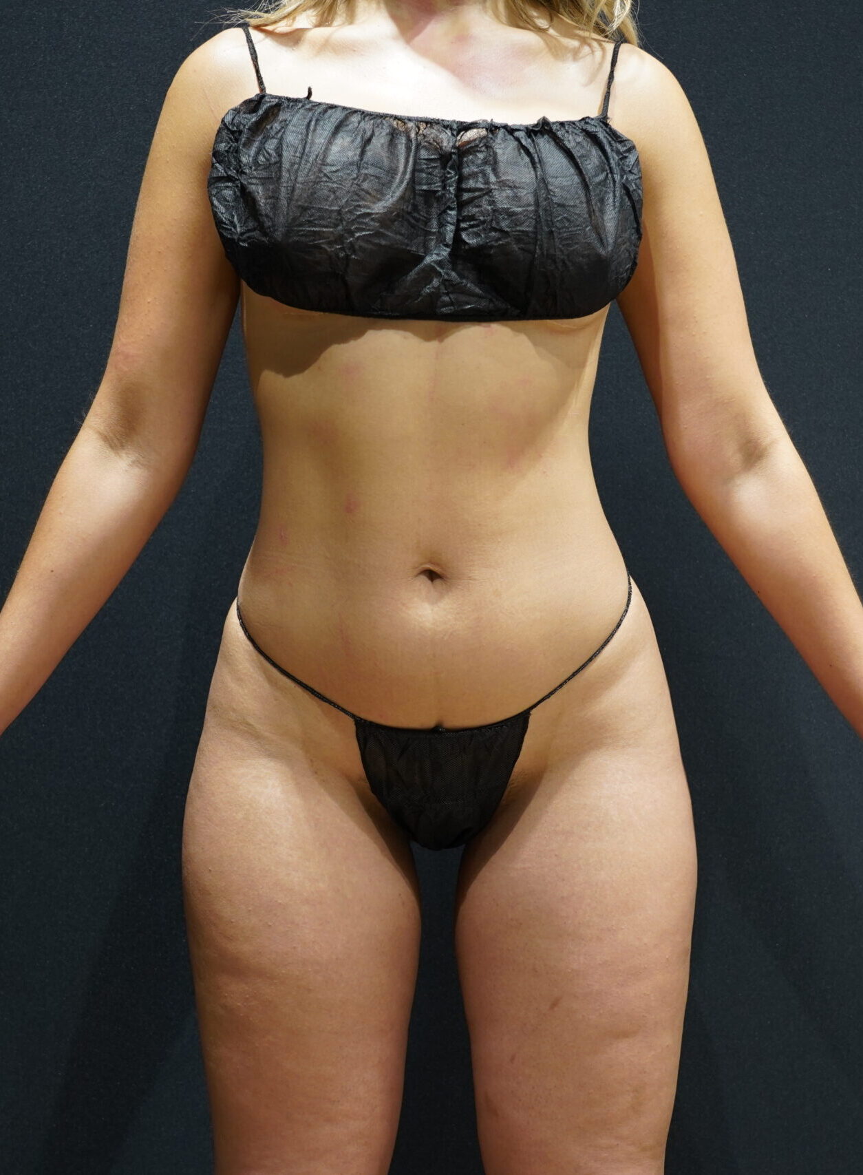 Before photo - 0° view