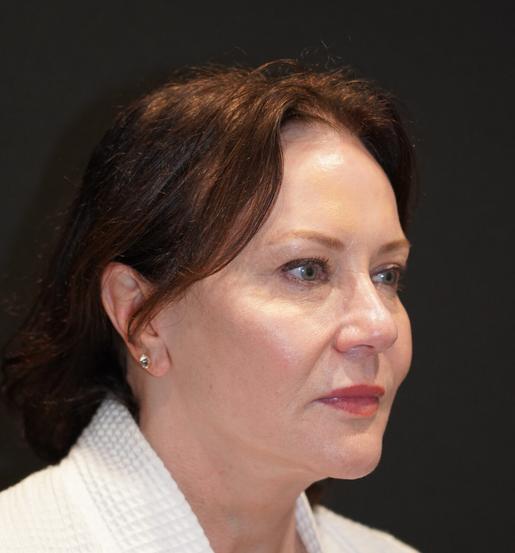 After photo - 45° view