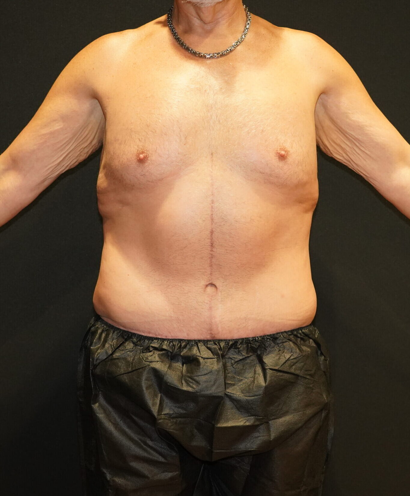 After photo - 0° view