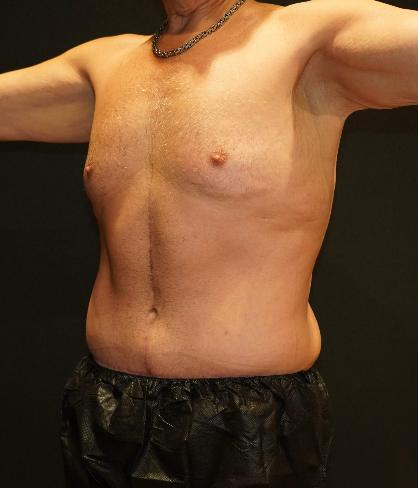 After photo - 45° view