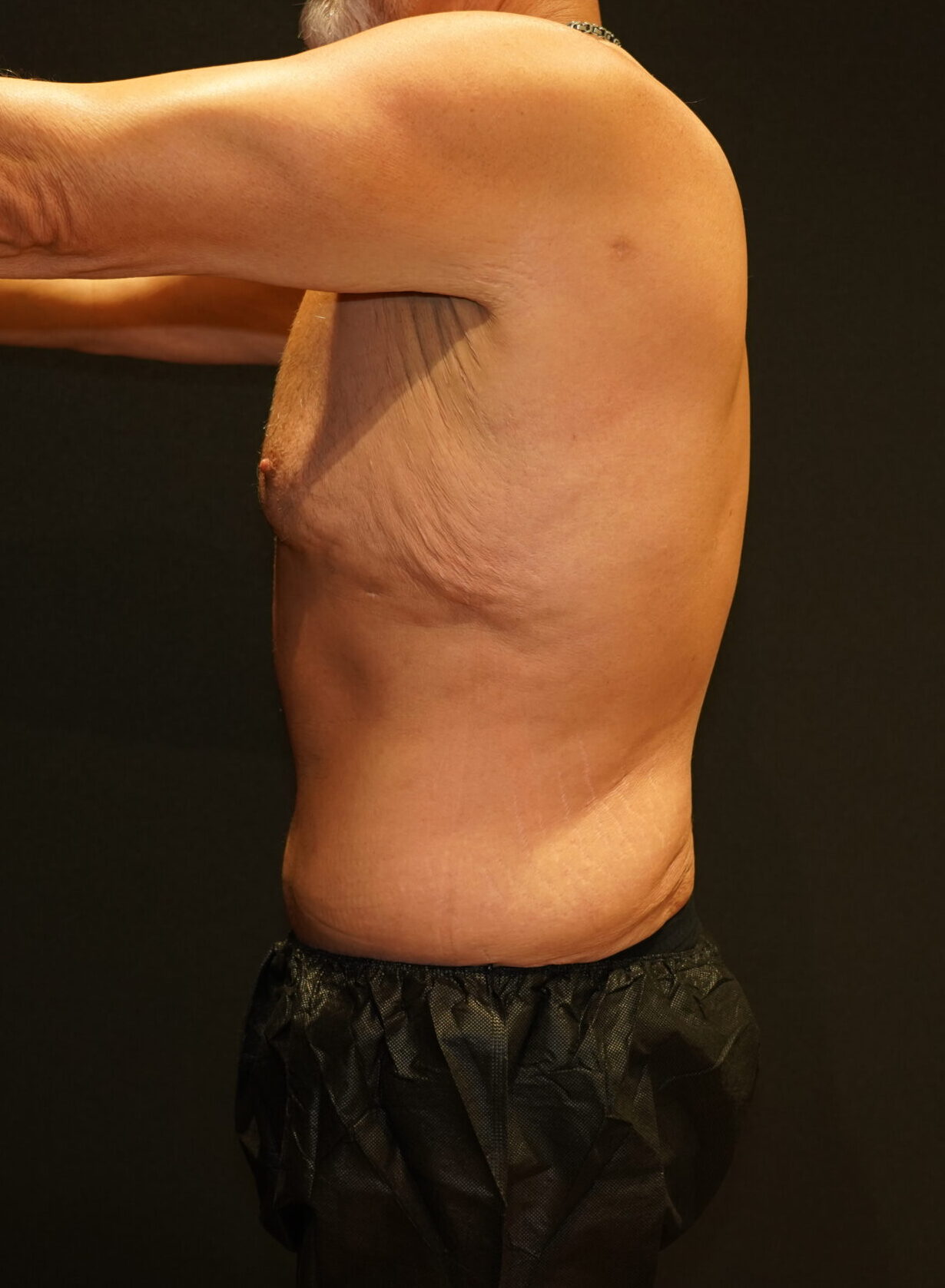 After photo - 90° view