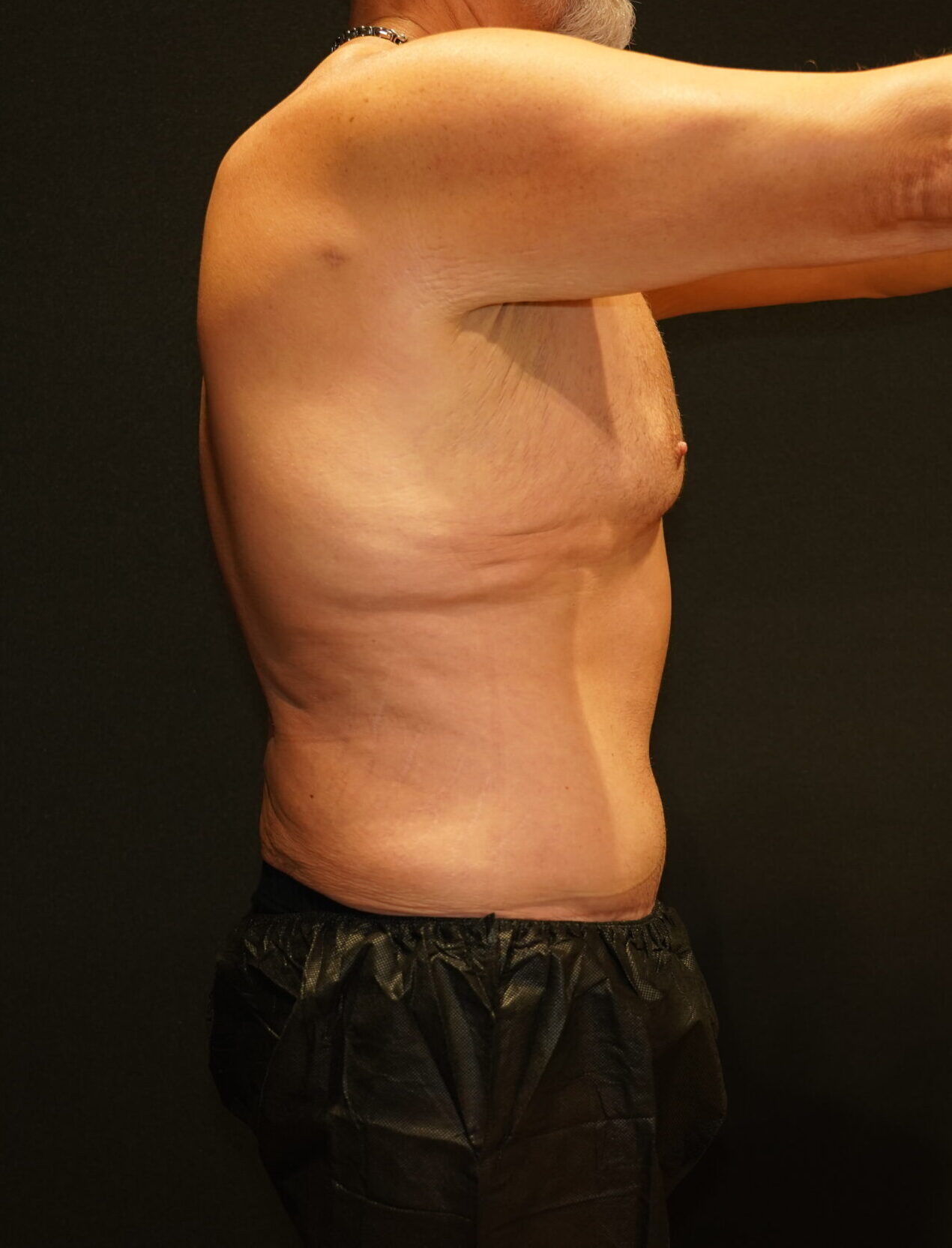 After photo - -90° view