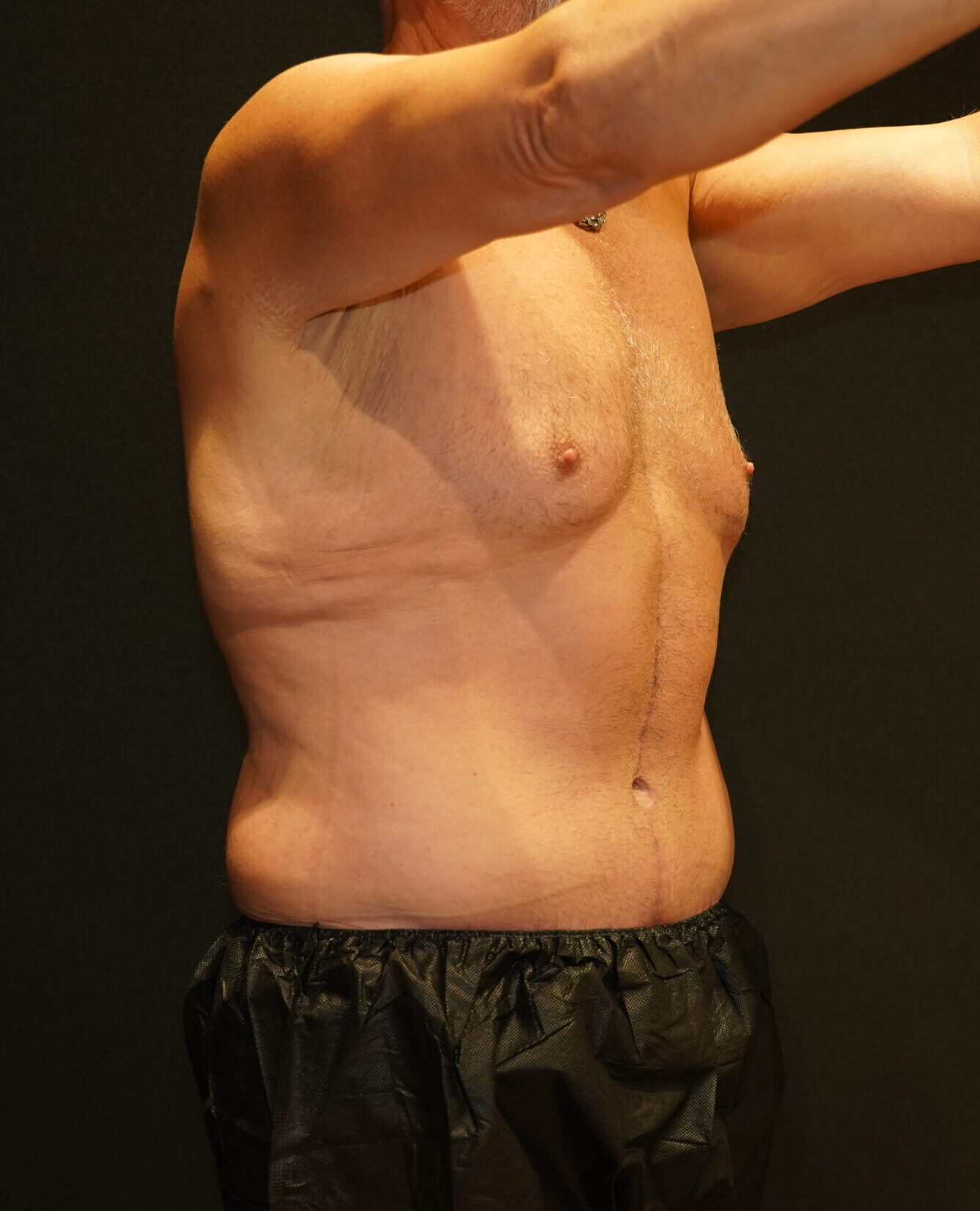 After photo - -45° view