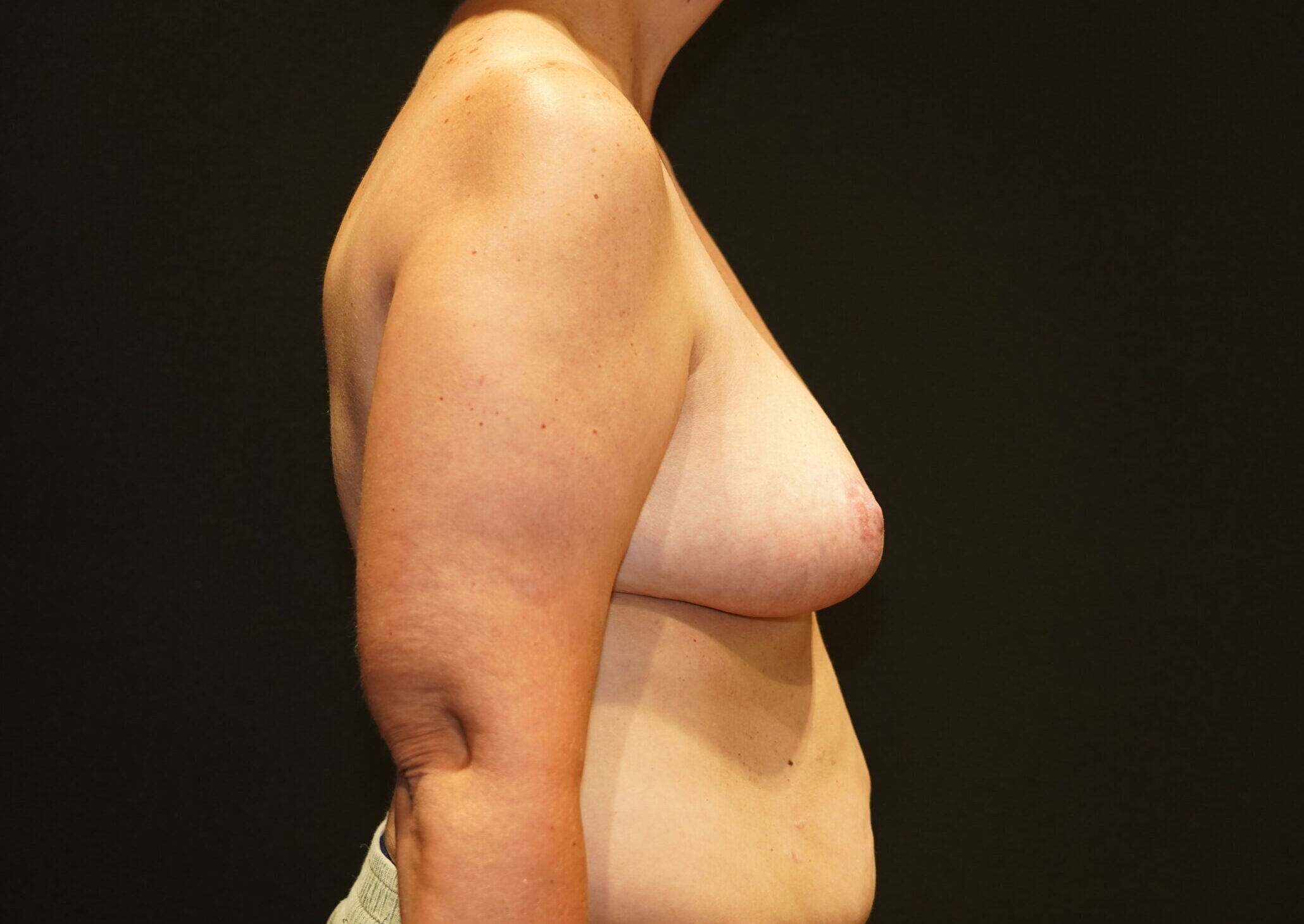 After photo - 90° view