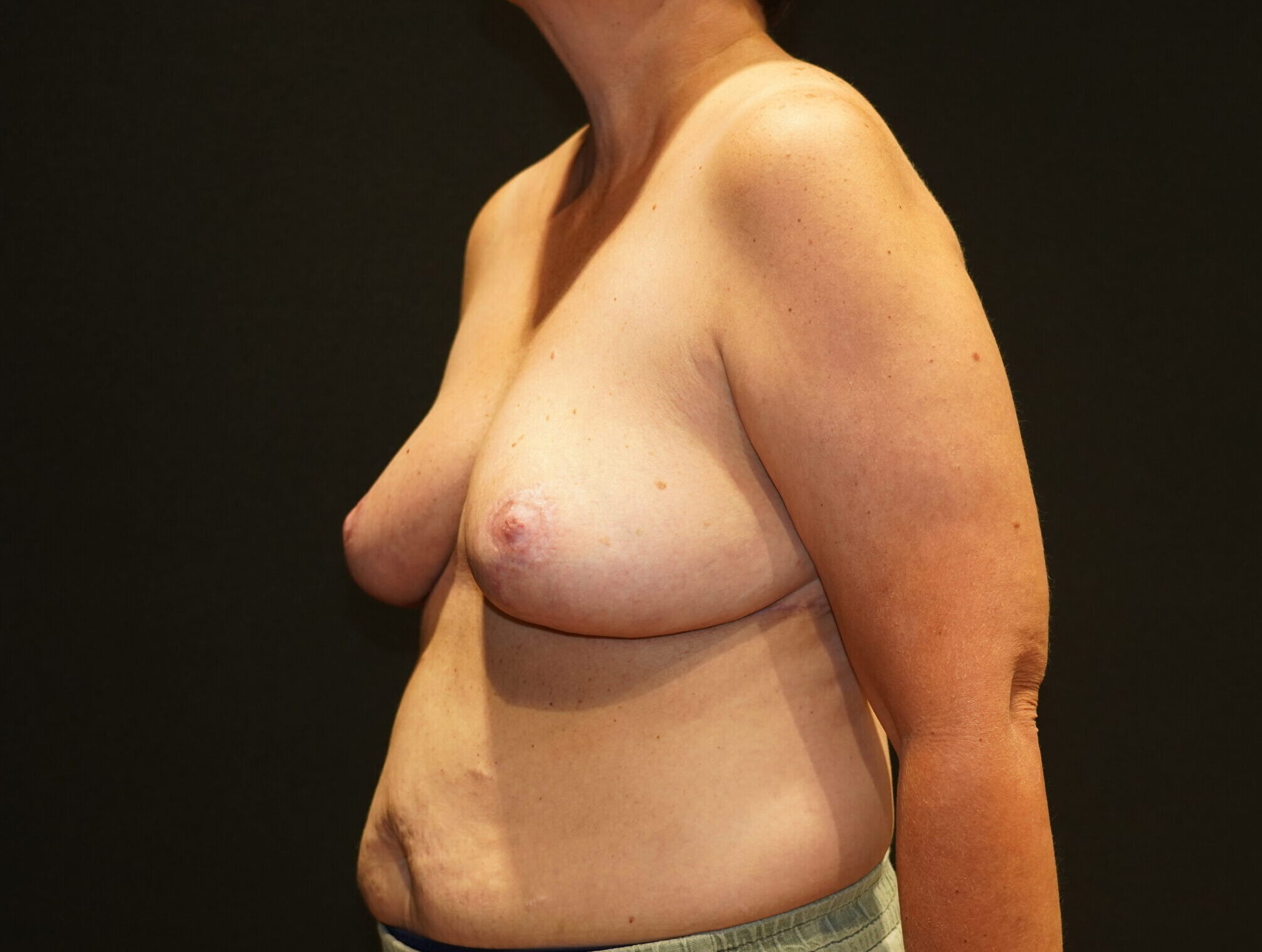 After photo - -45° view