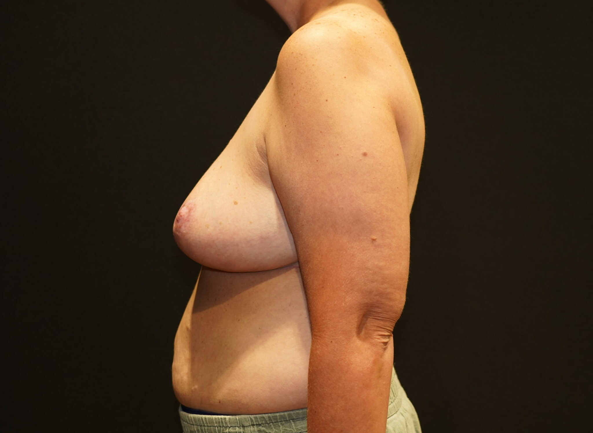 After photo - -90° view