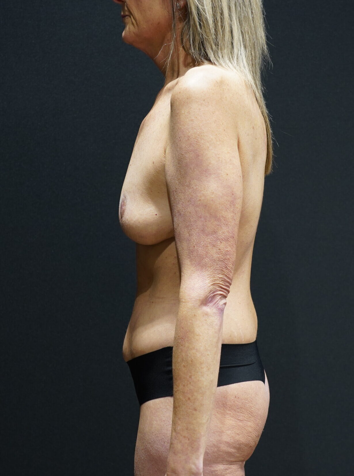 After photo - -90° view