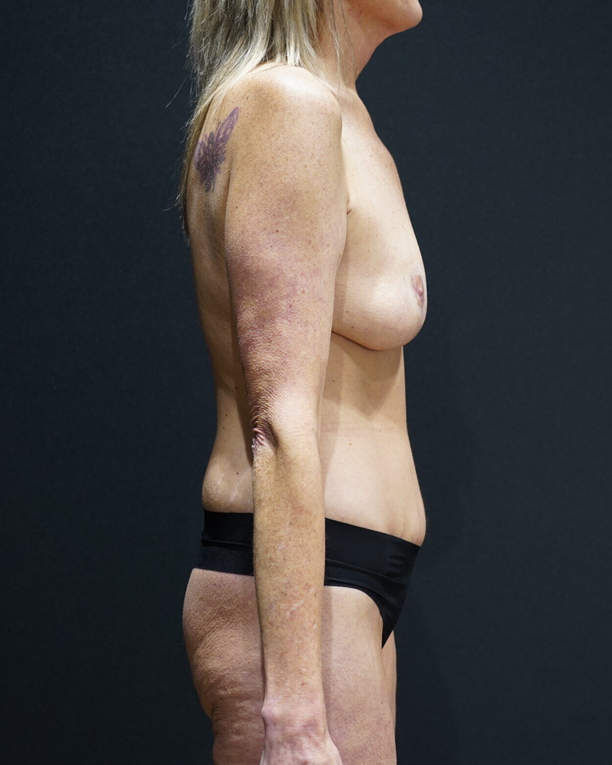 After photo - 90° view