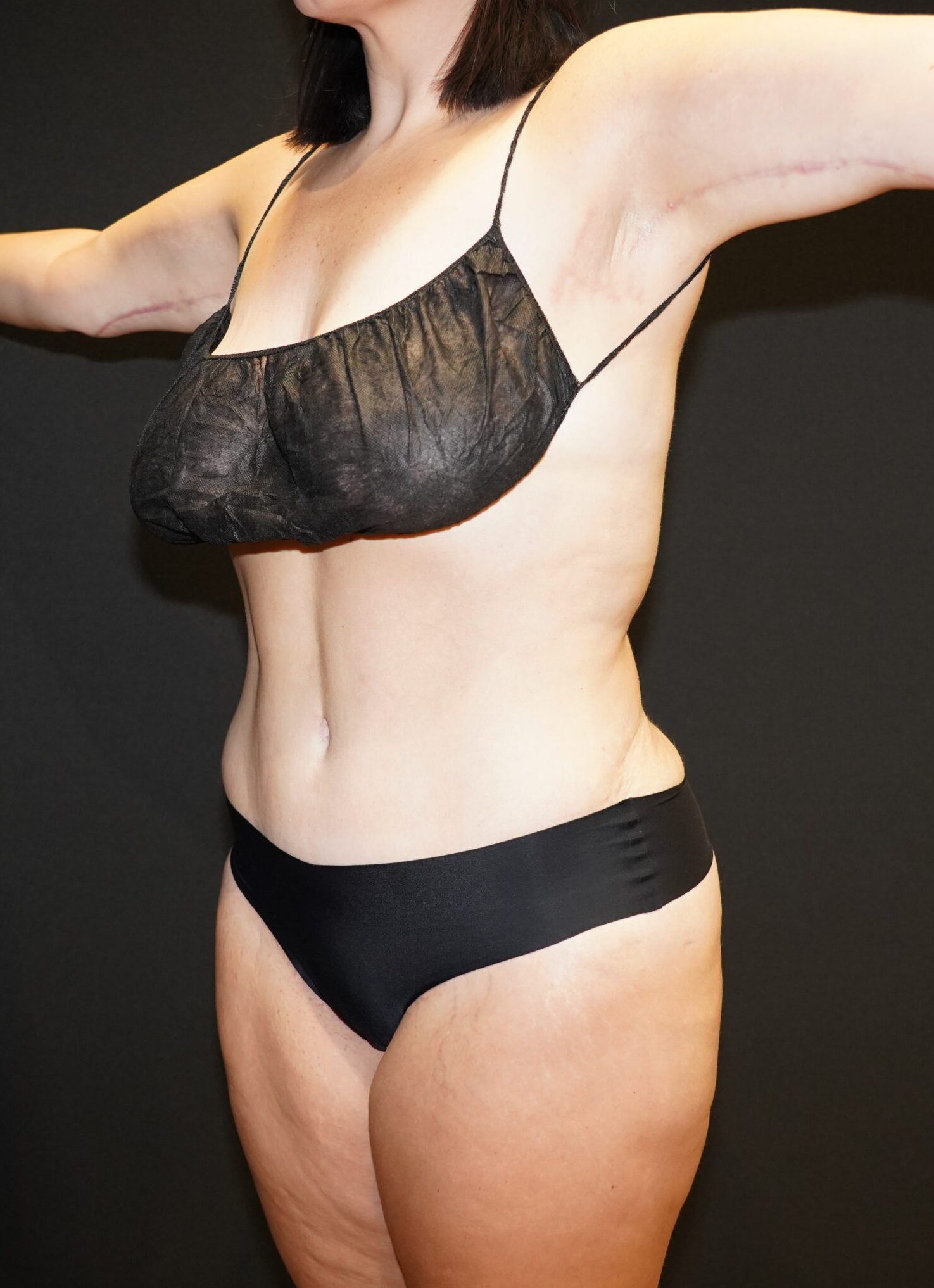 After photo - -45° view