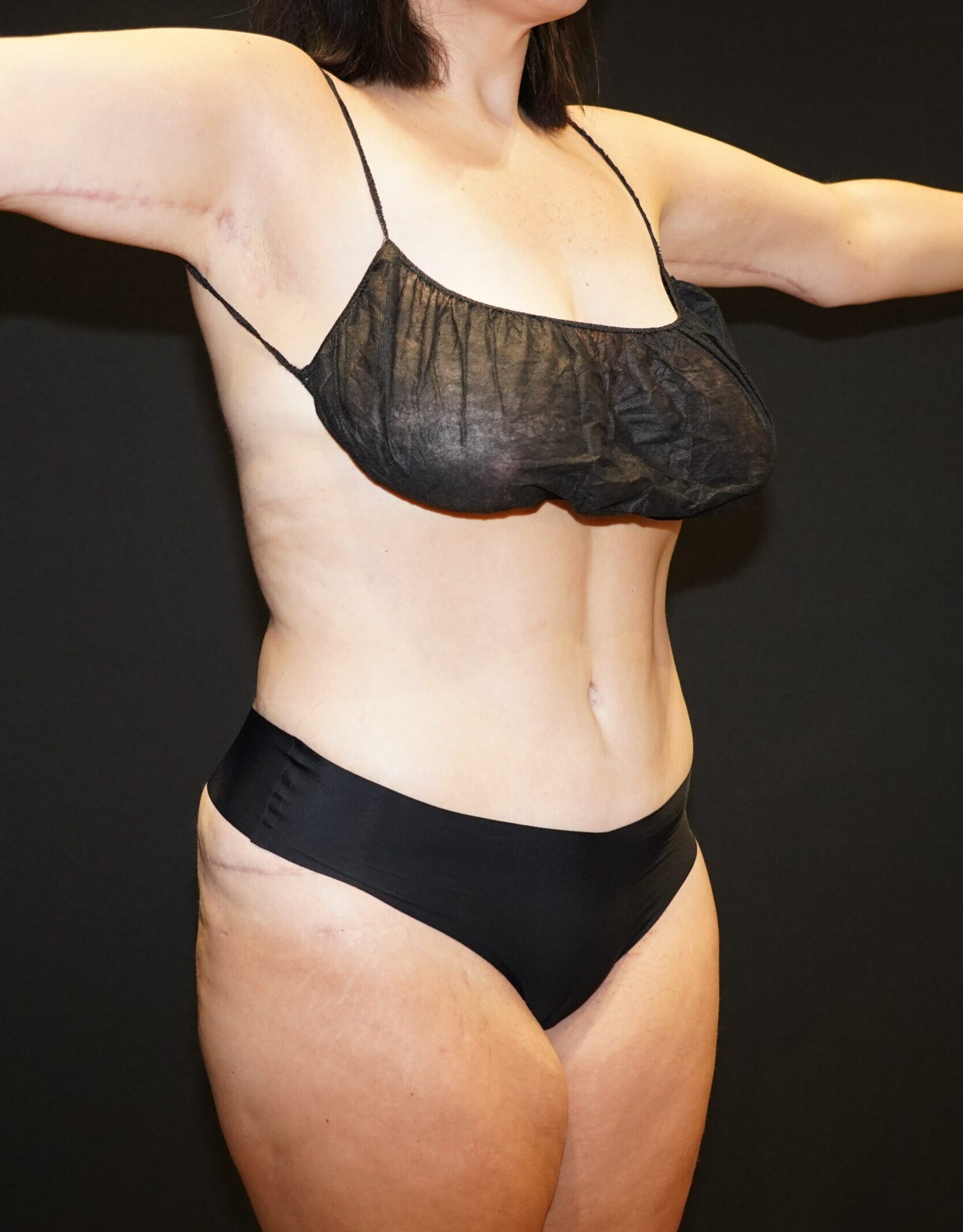 After photo - 45° view