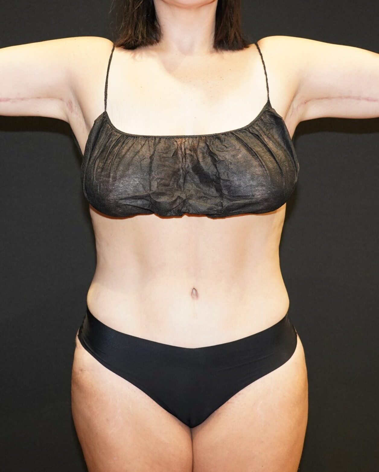 After photo - 0° view