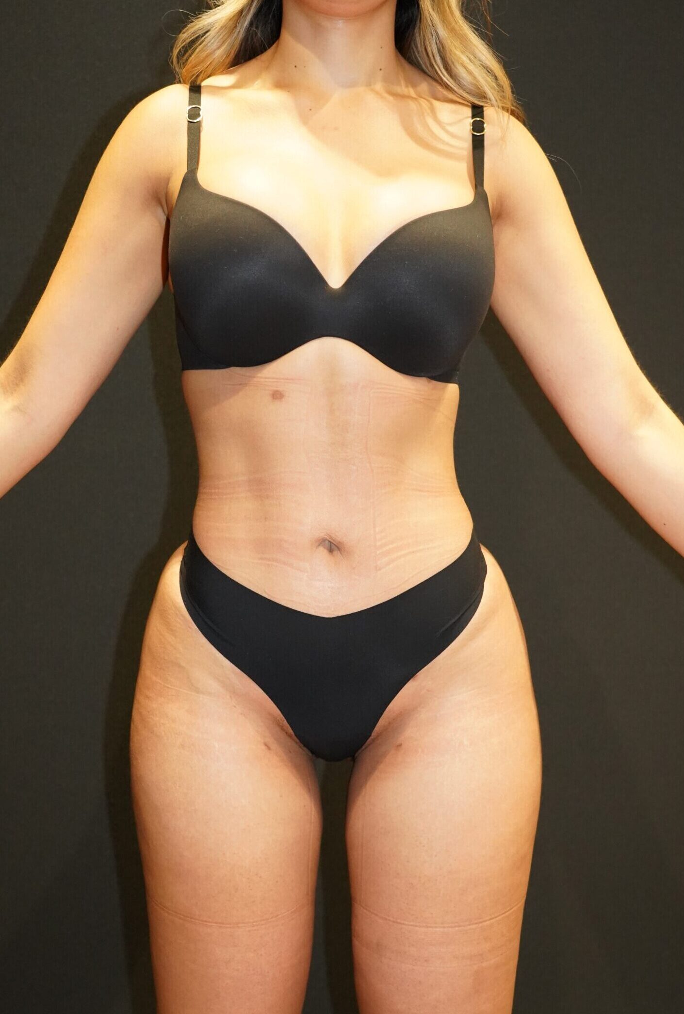 After photo - 0° view