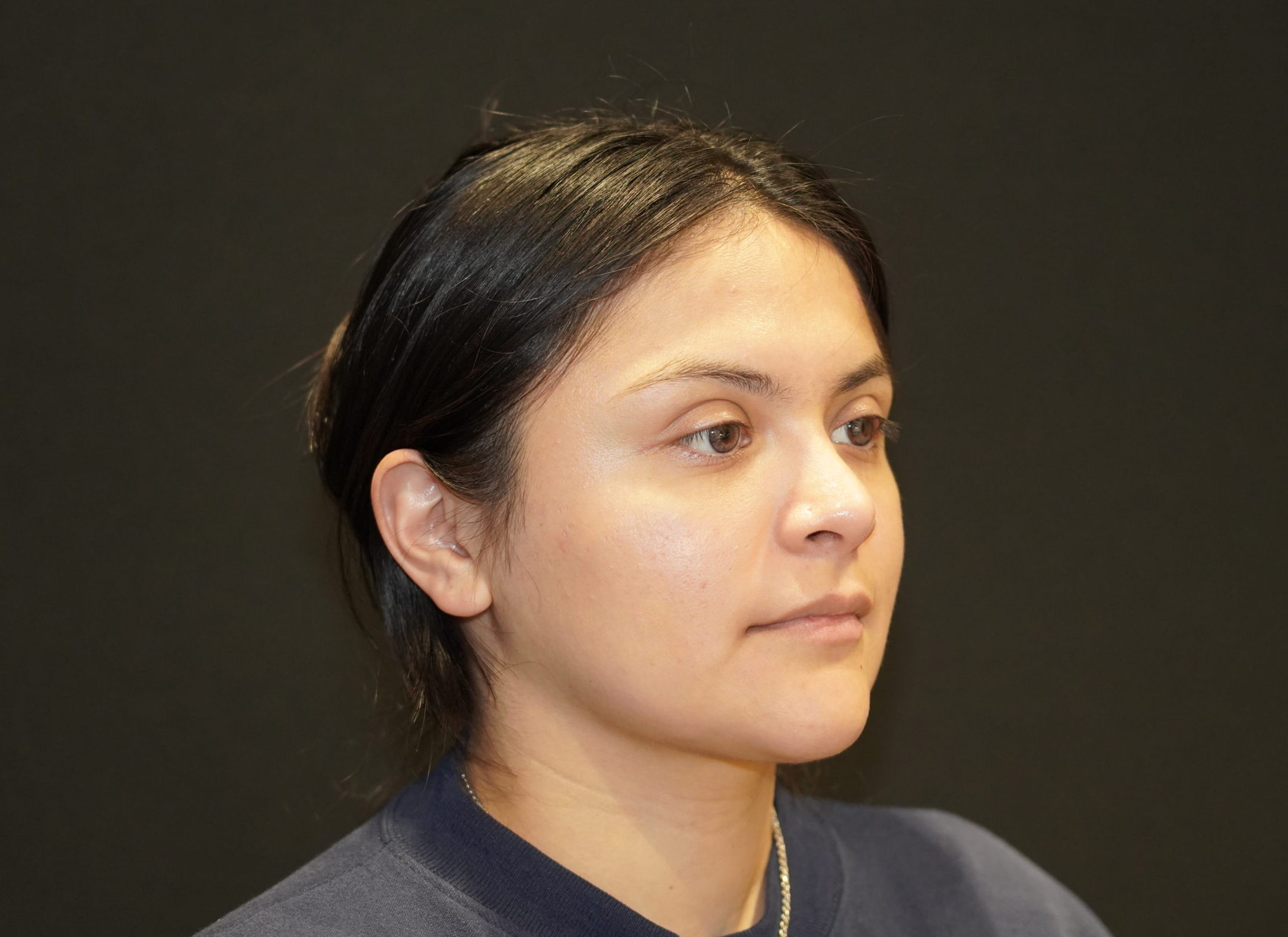 After photo - 45° view