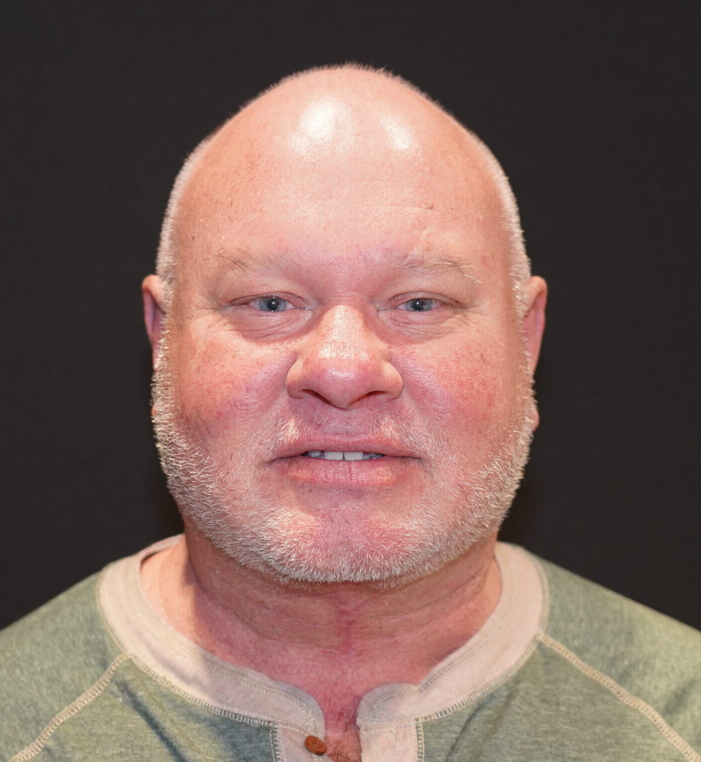 After photo - 0° view