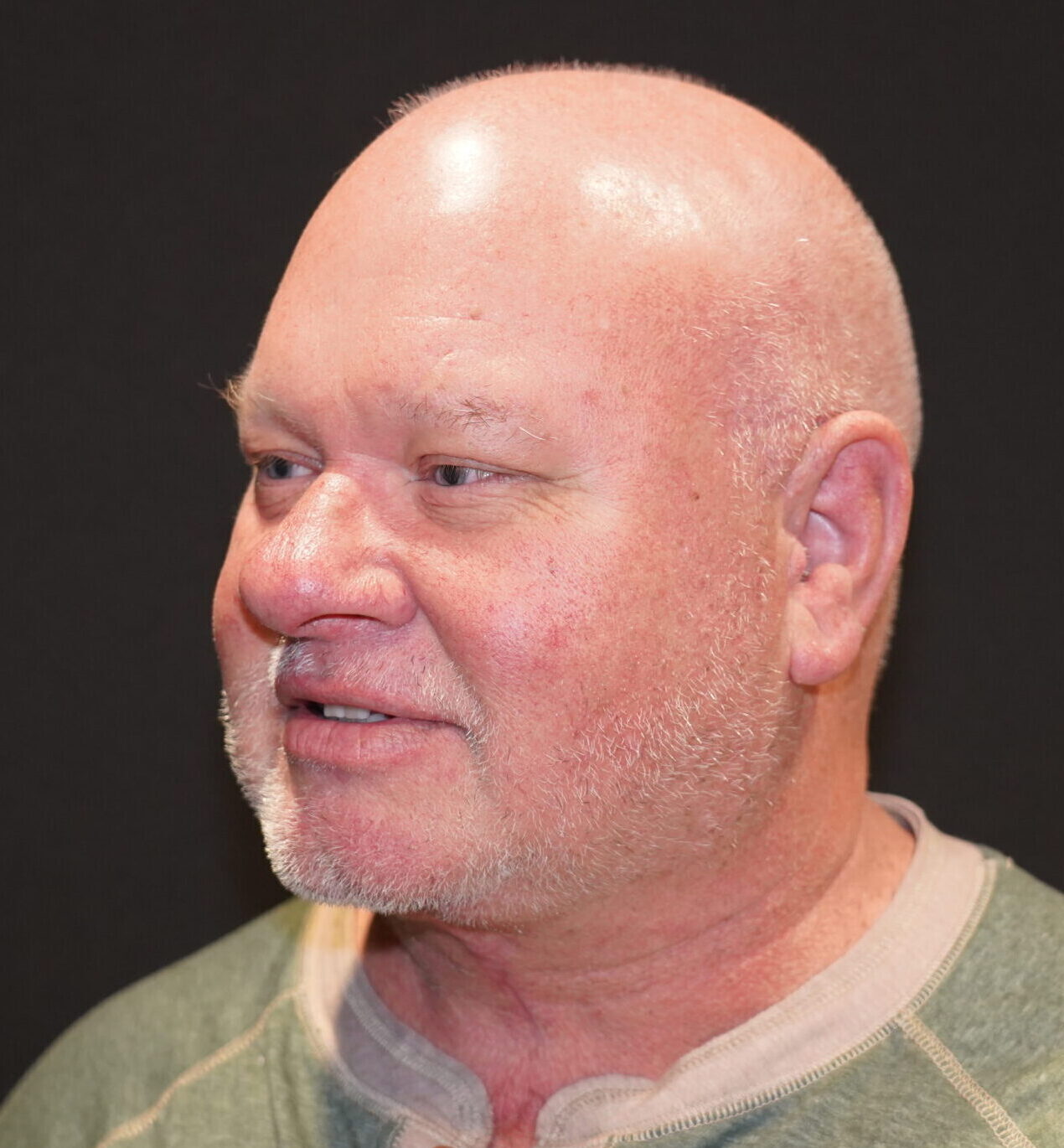 After photo - 45° view