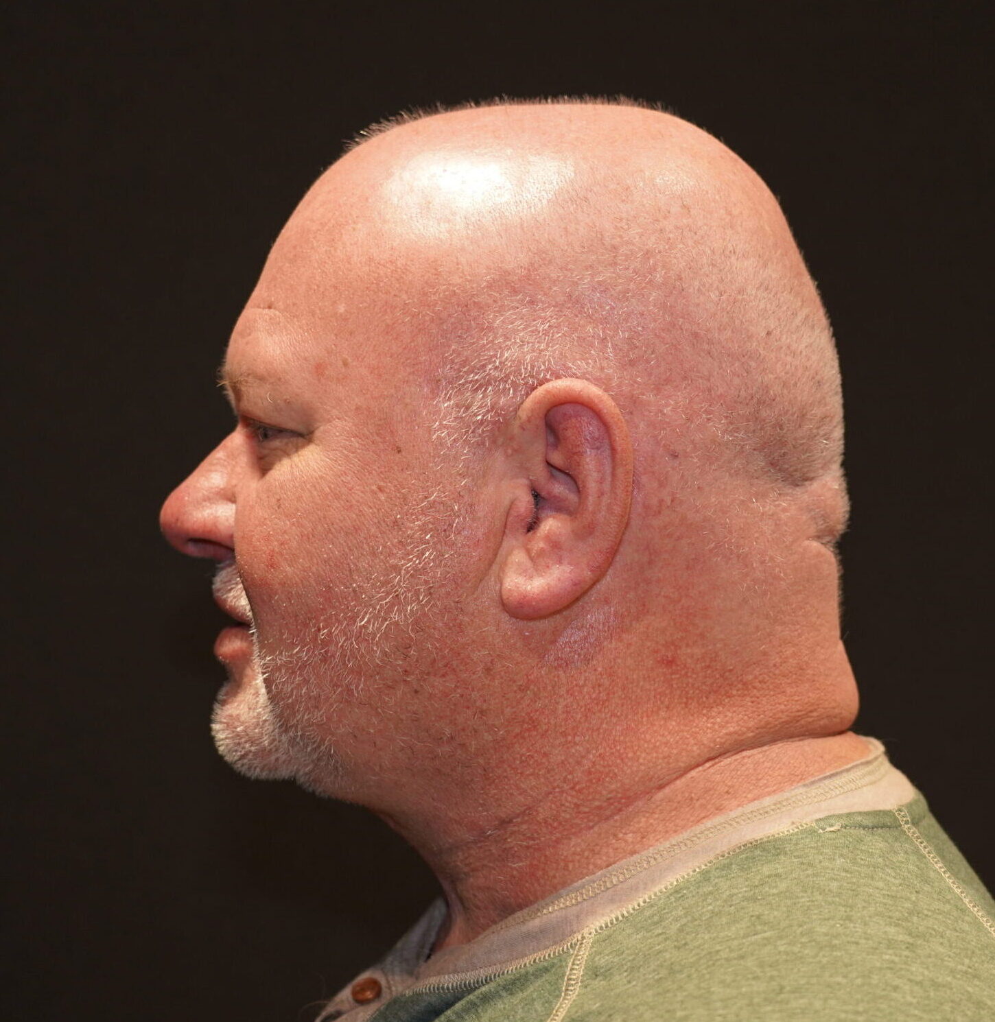 After photo - -90° view