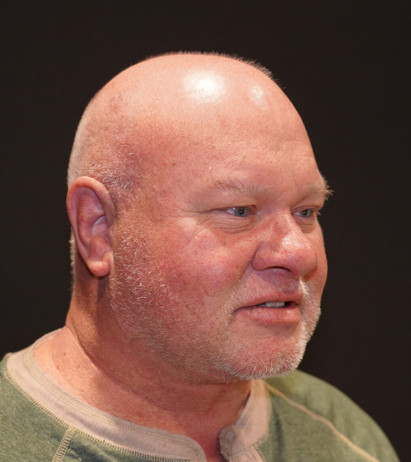 After photo - -45° view