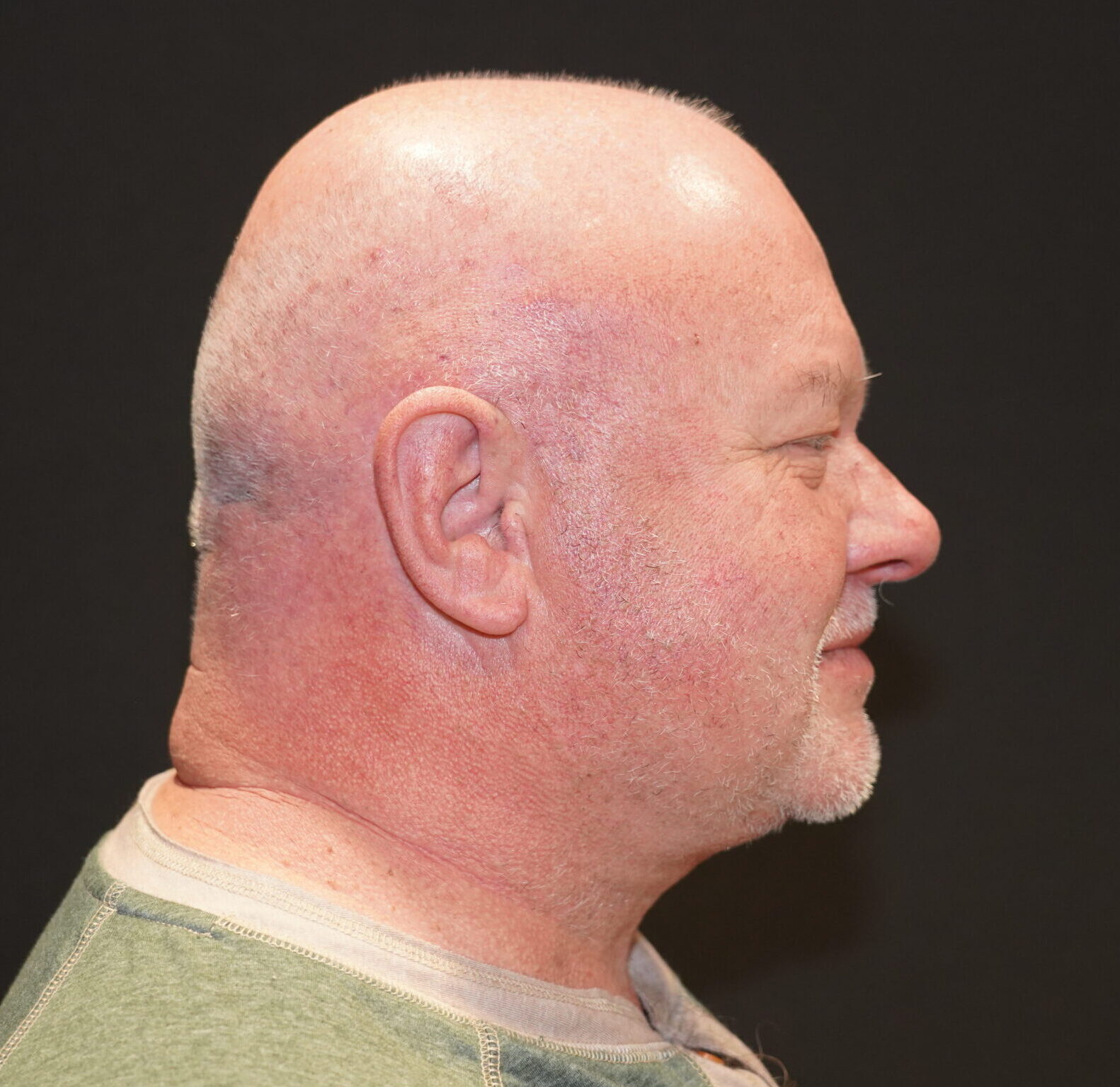 After photo - 90° view