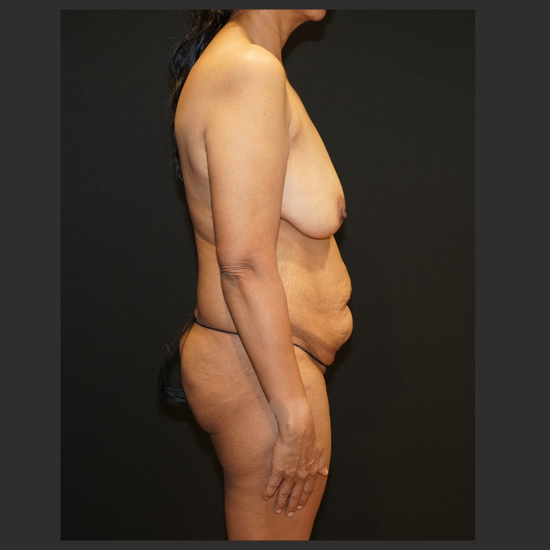 Case--3486 | Before Body Procedures