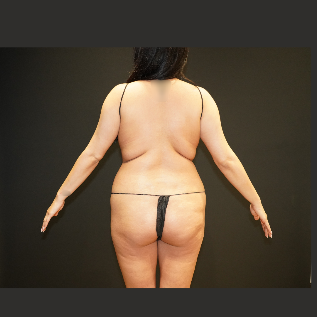 Case--2148 | Before Brazilian Butt Lift