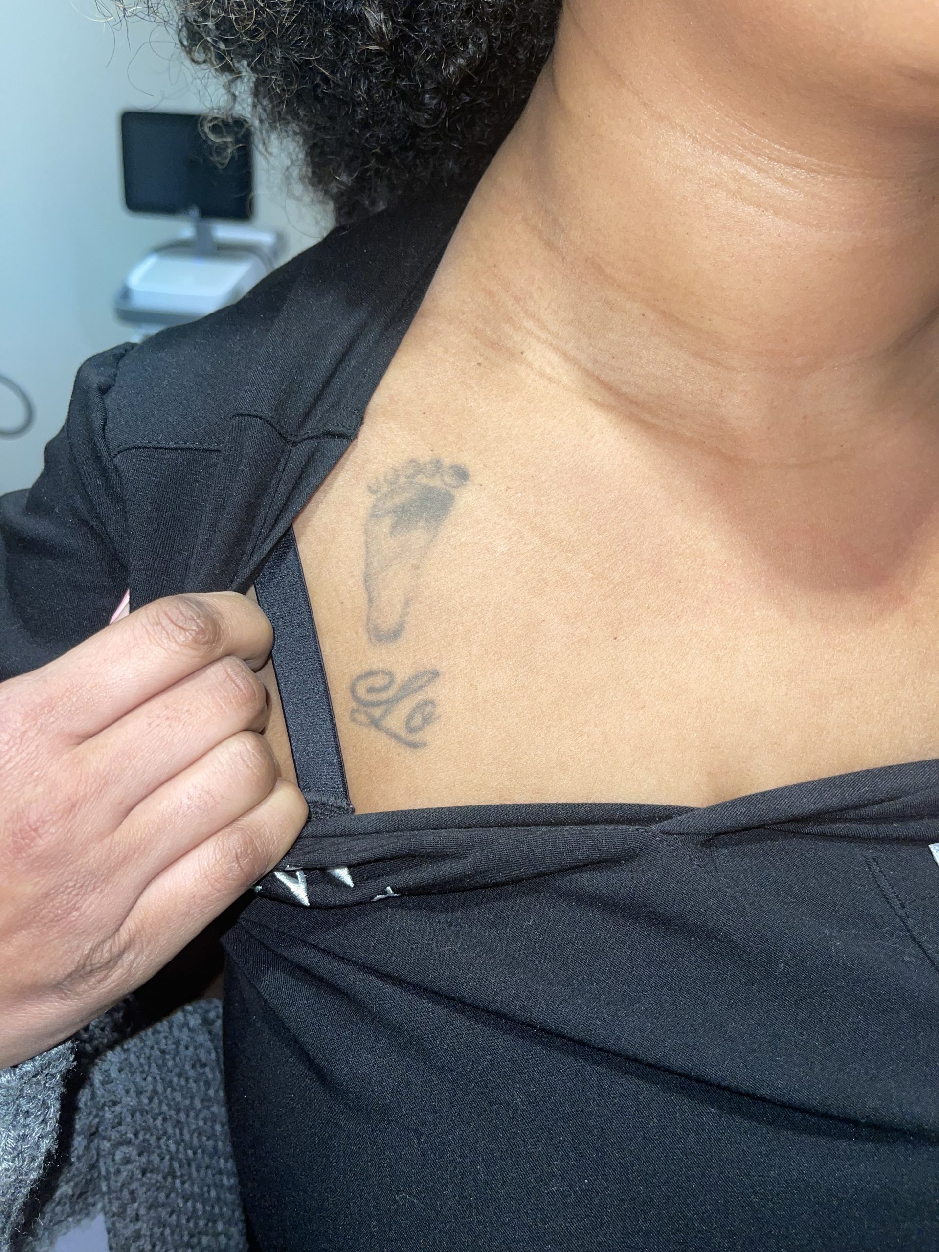 Case--7488 | Before Tattoo Removal