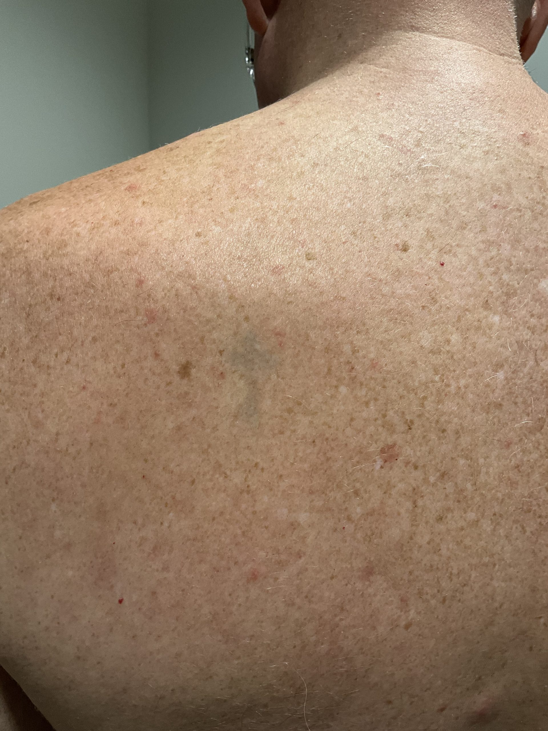 Case--9586 | After Tattoo Removal