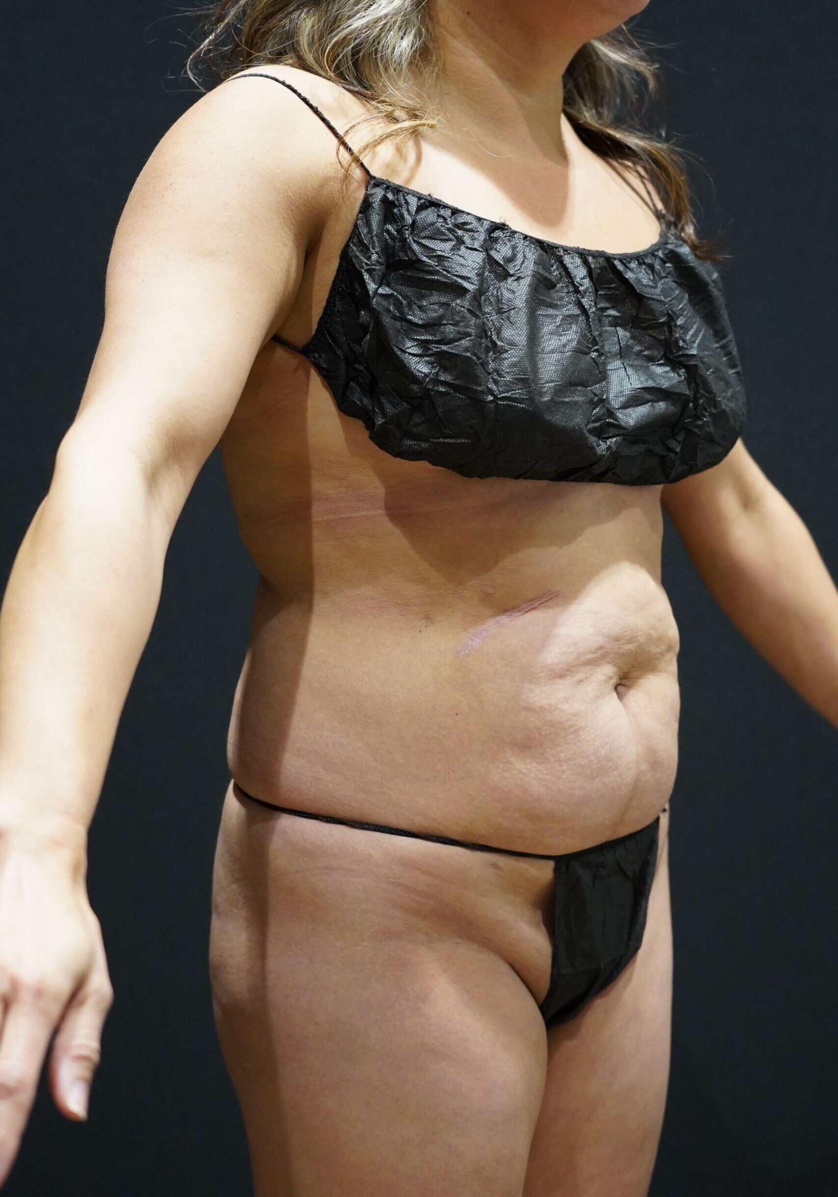 Before photo - 45° view