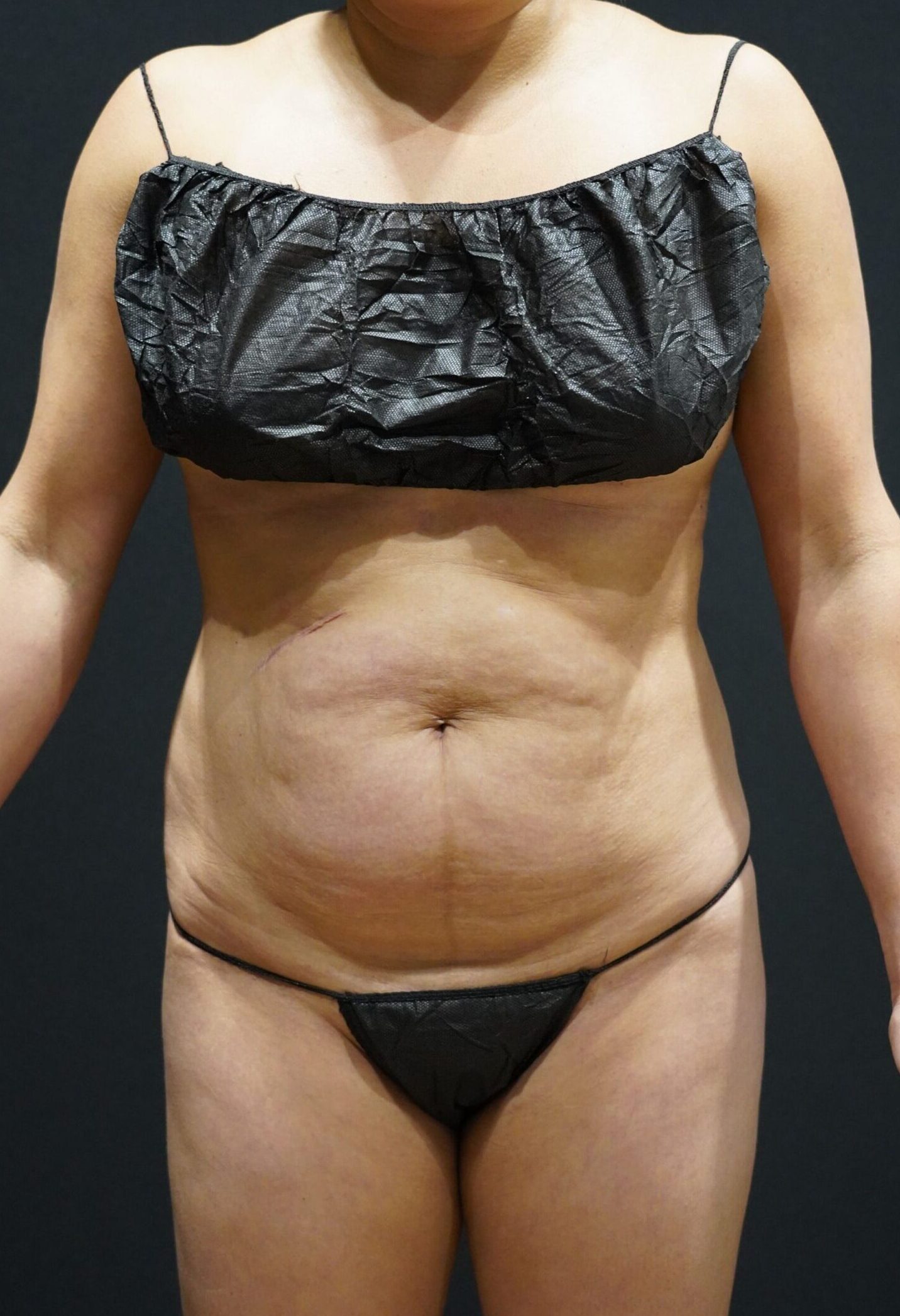 Before photo - 0° view