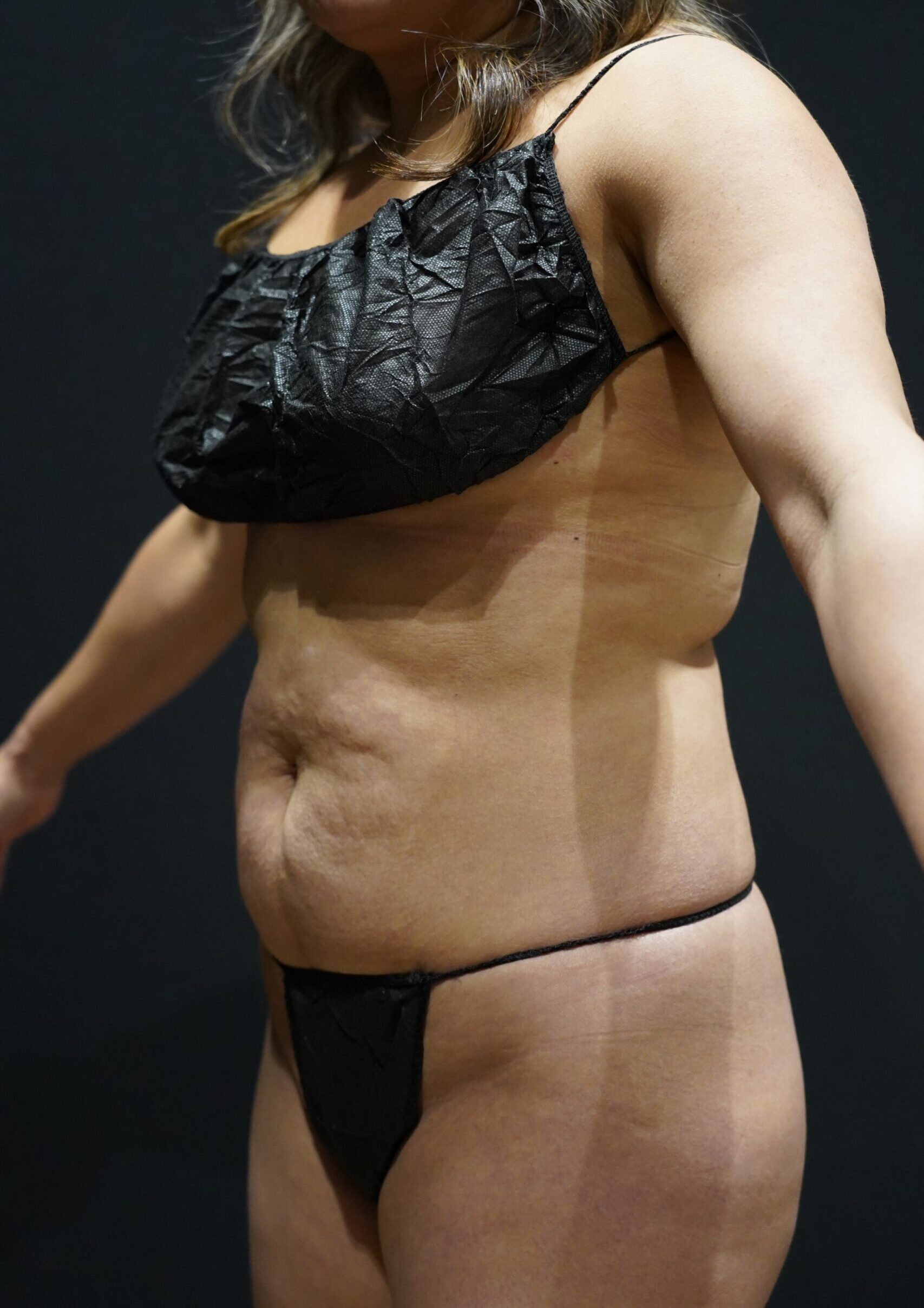 Before photo - -45° view