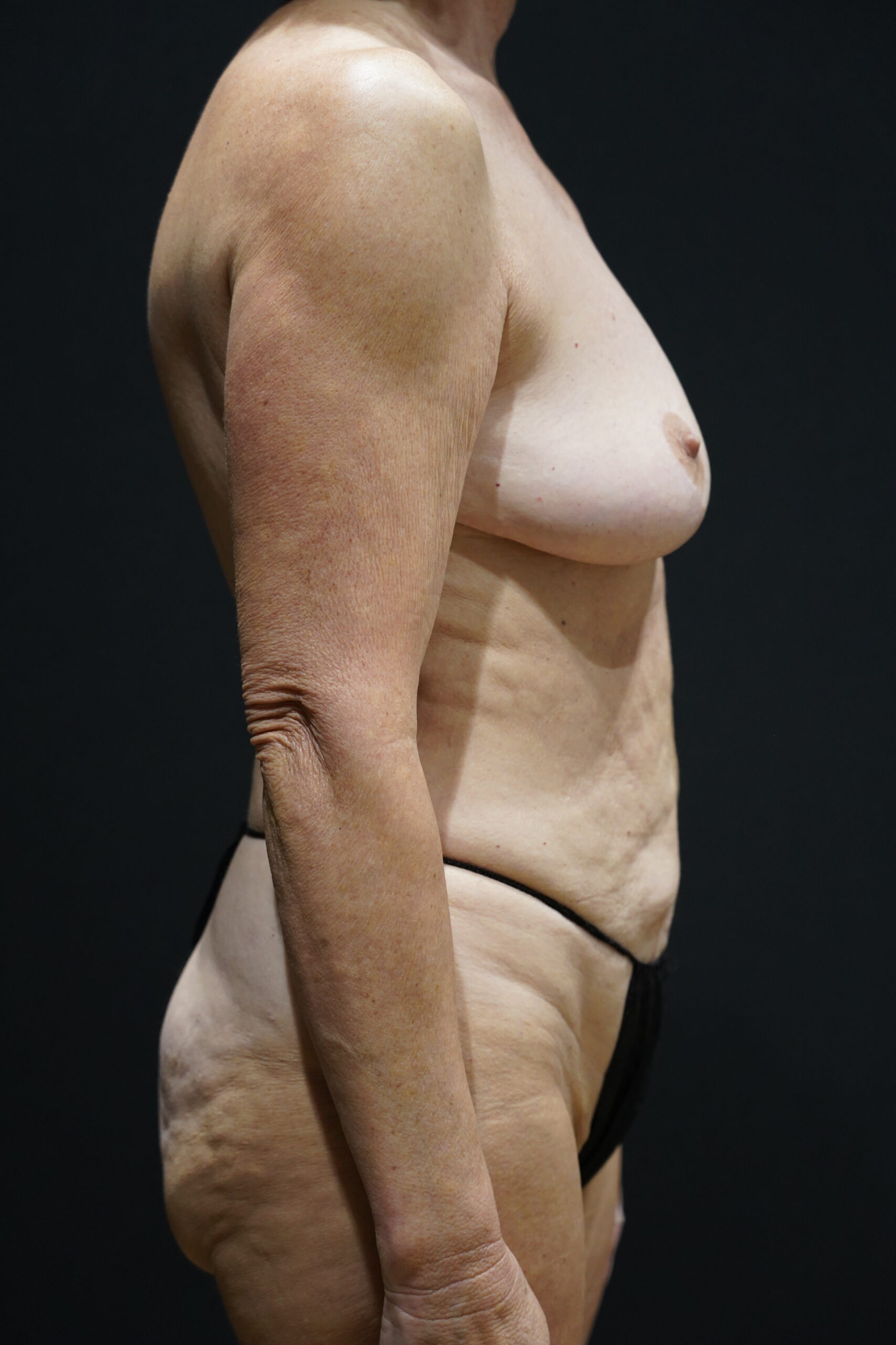 Case--2262 | Before Breast Lift with Augmentation 5